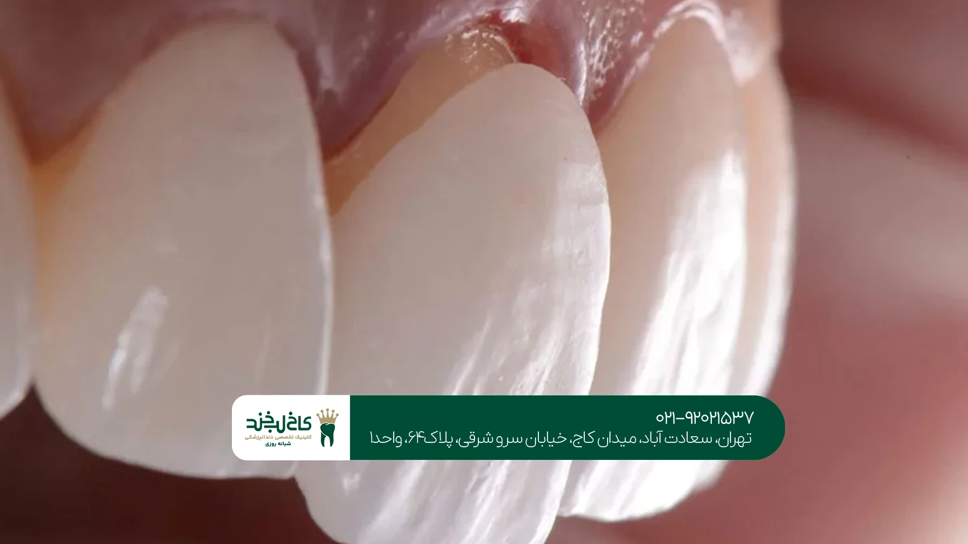 لمینت دندان در تهران لمینت دندان در تهران