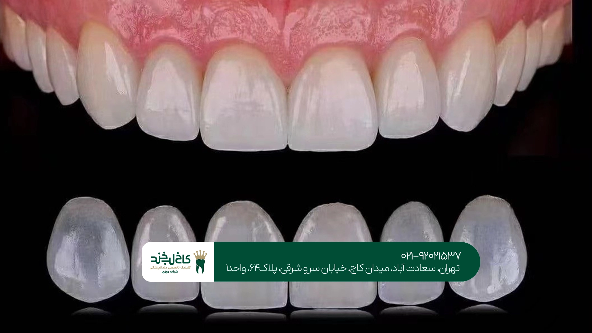 مراحل انجام لمینت سرامیکی در تهران مراحل انجام لمینت سرامیکی در تهران