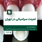 لمینت سرامیکی در تهران