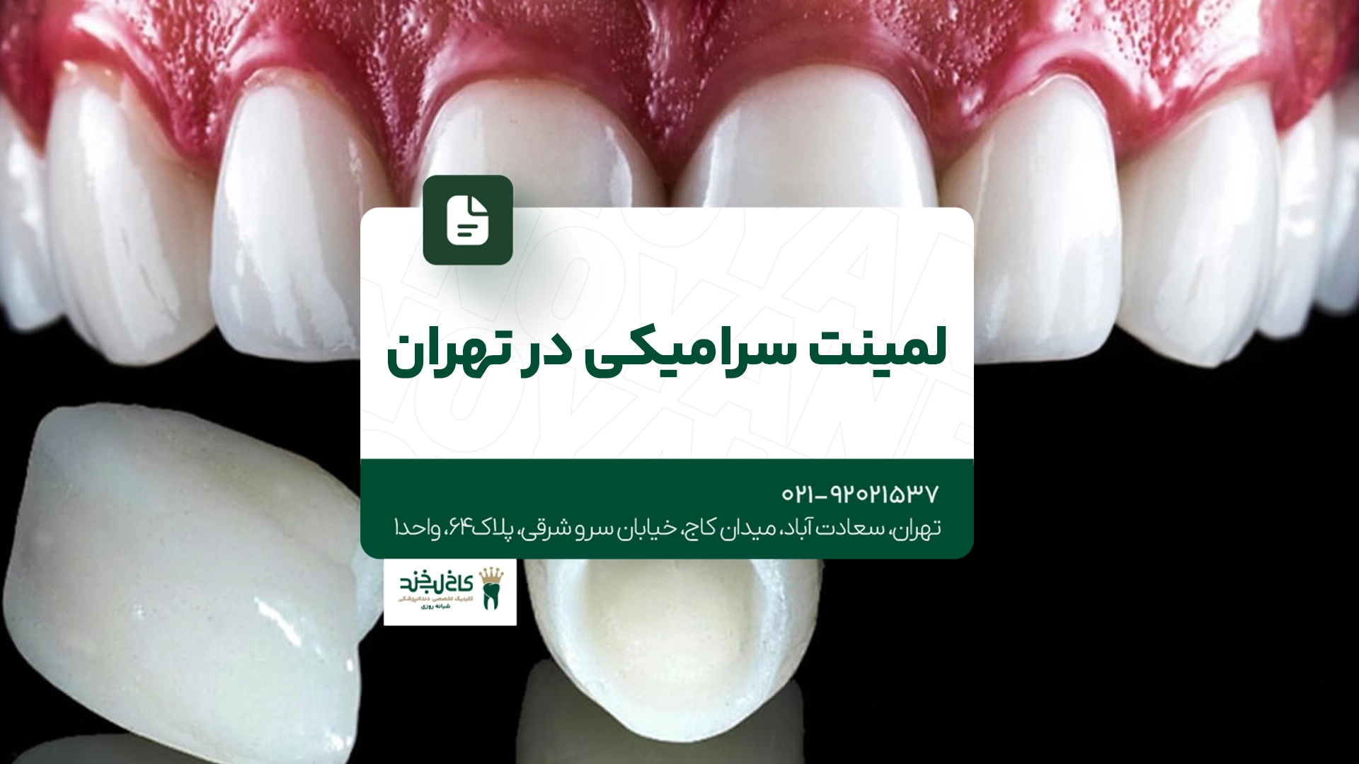 لمینت سرامیکی در تهران لمینت سرامیکی در تهران