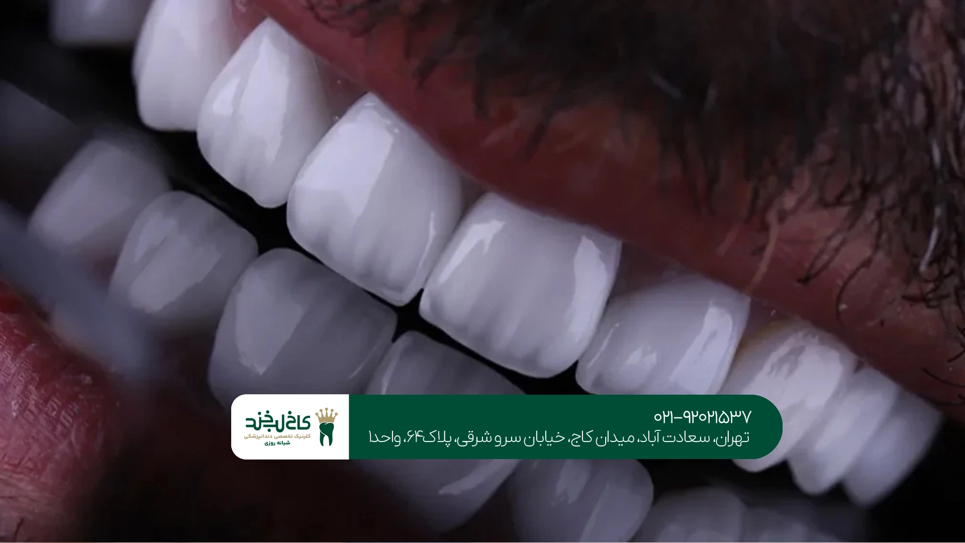ماندگاری لمینت و کامپوزیت دندان چقدر است
