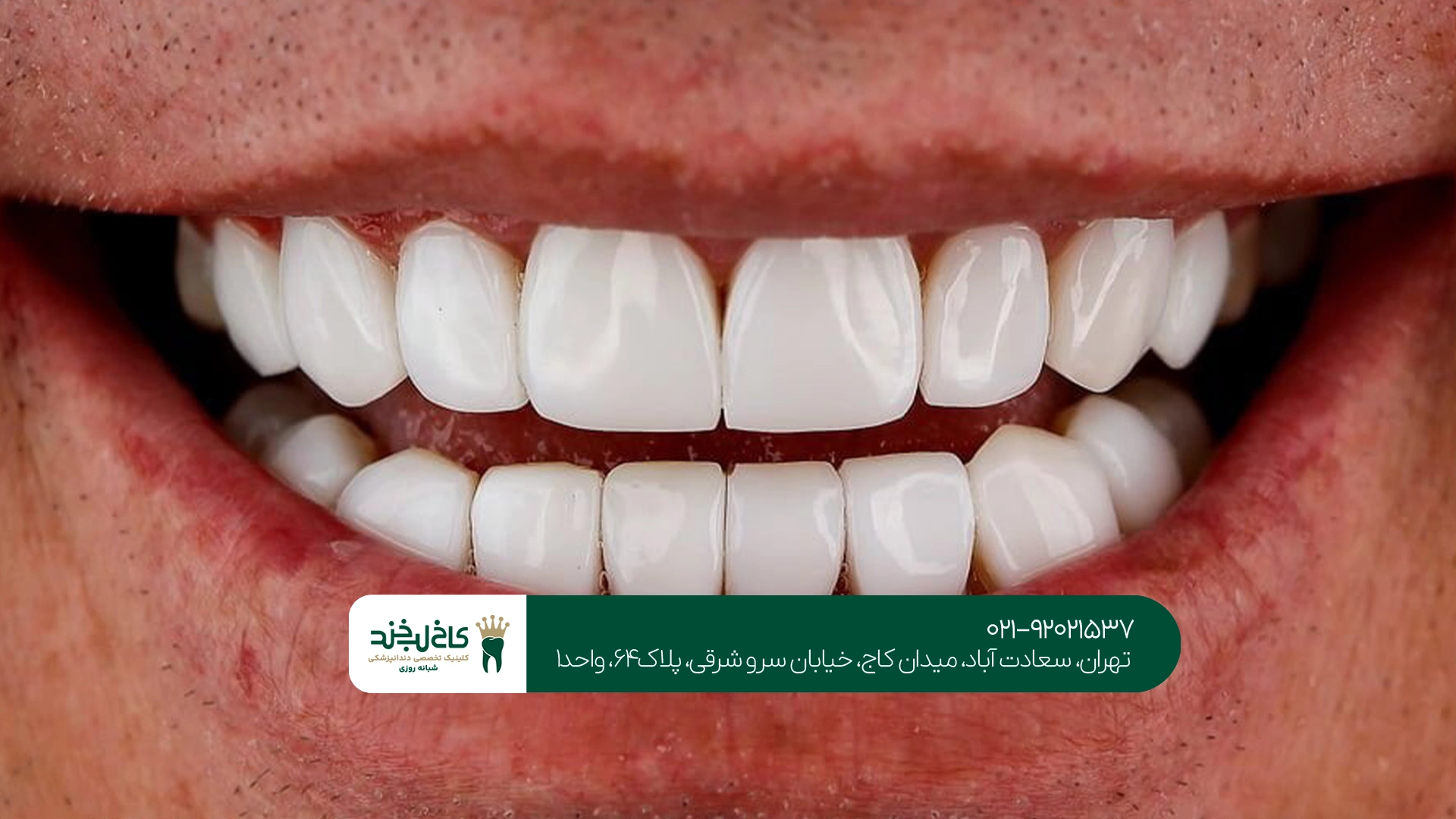 کلینیک لمینت و کامپوزیت دندان در تهران