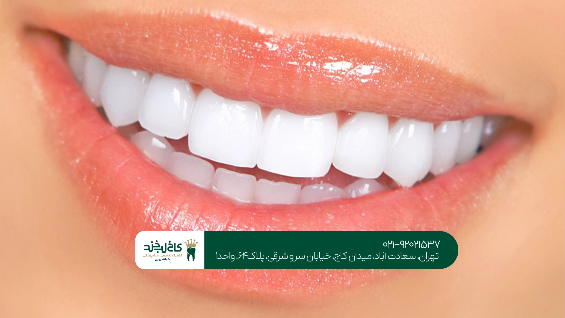 تفاوت لمینت و کامپوزیت دندان چیست
