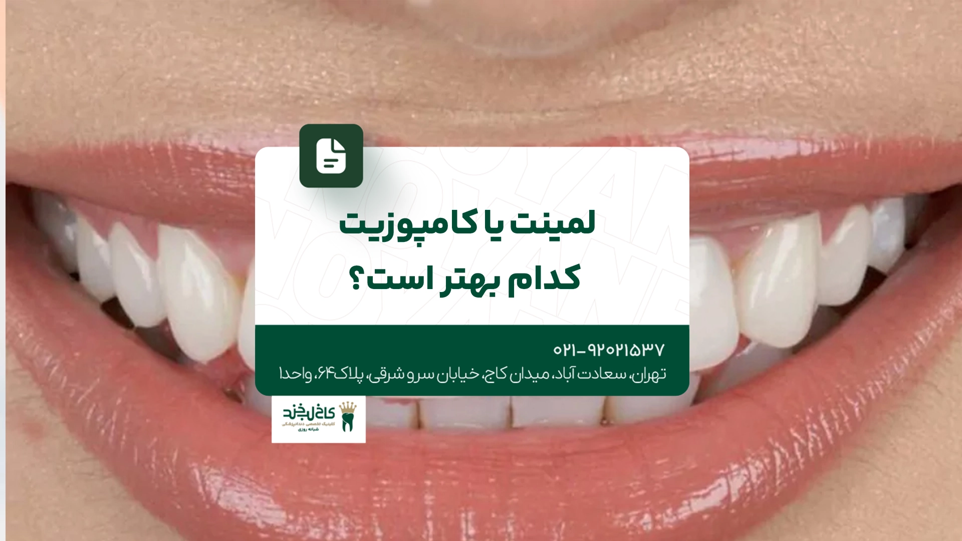 لمینت یا کامپوزیت کدام بهتر است