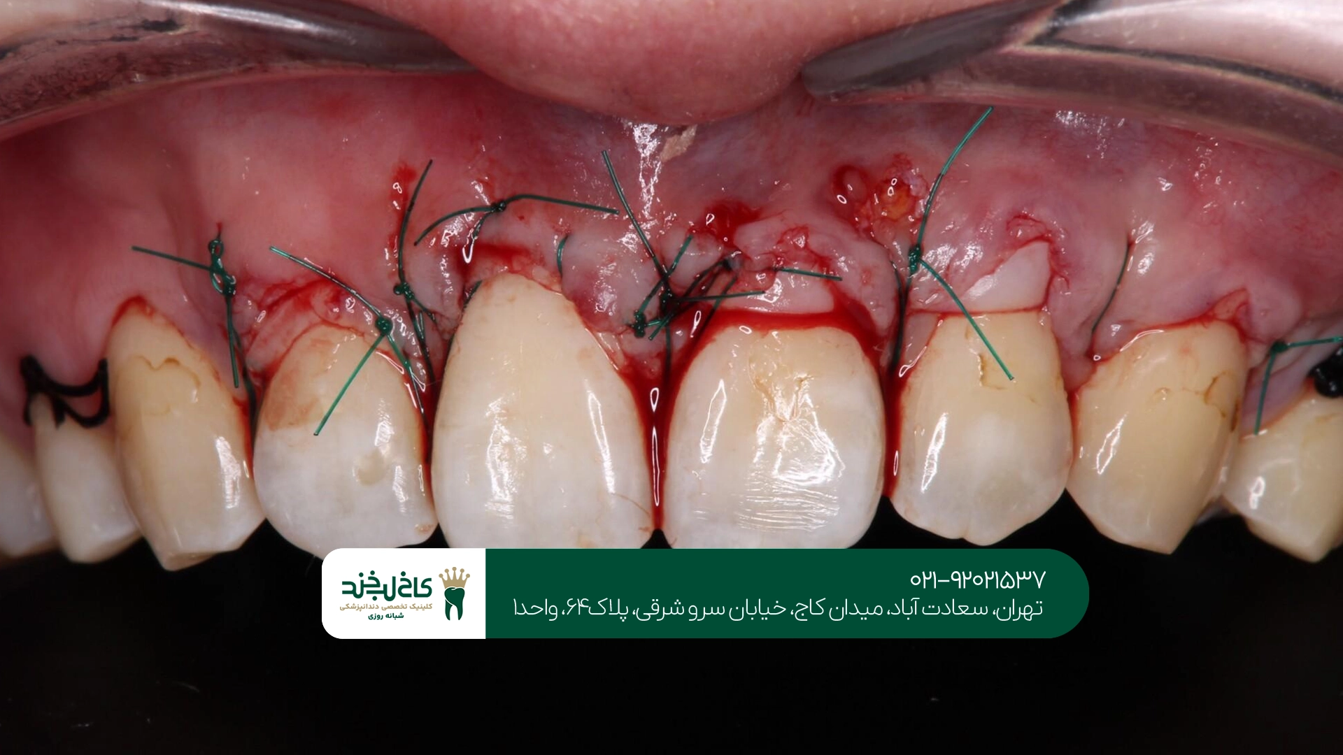مزایای مراجعه به متخصص جراحی لثه