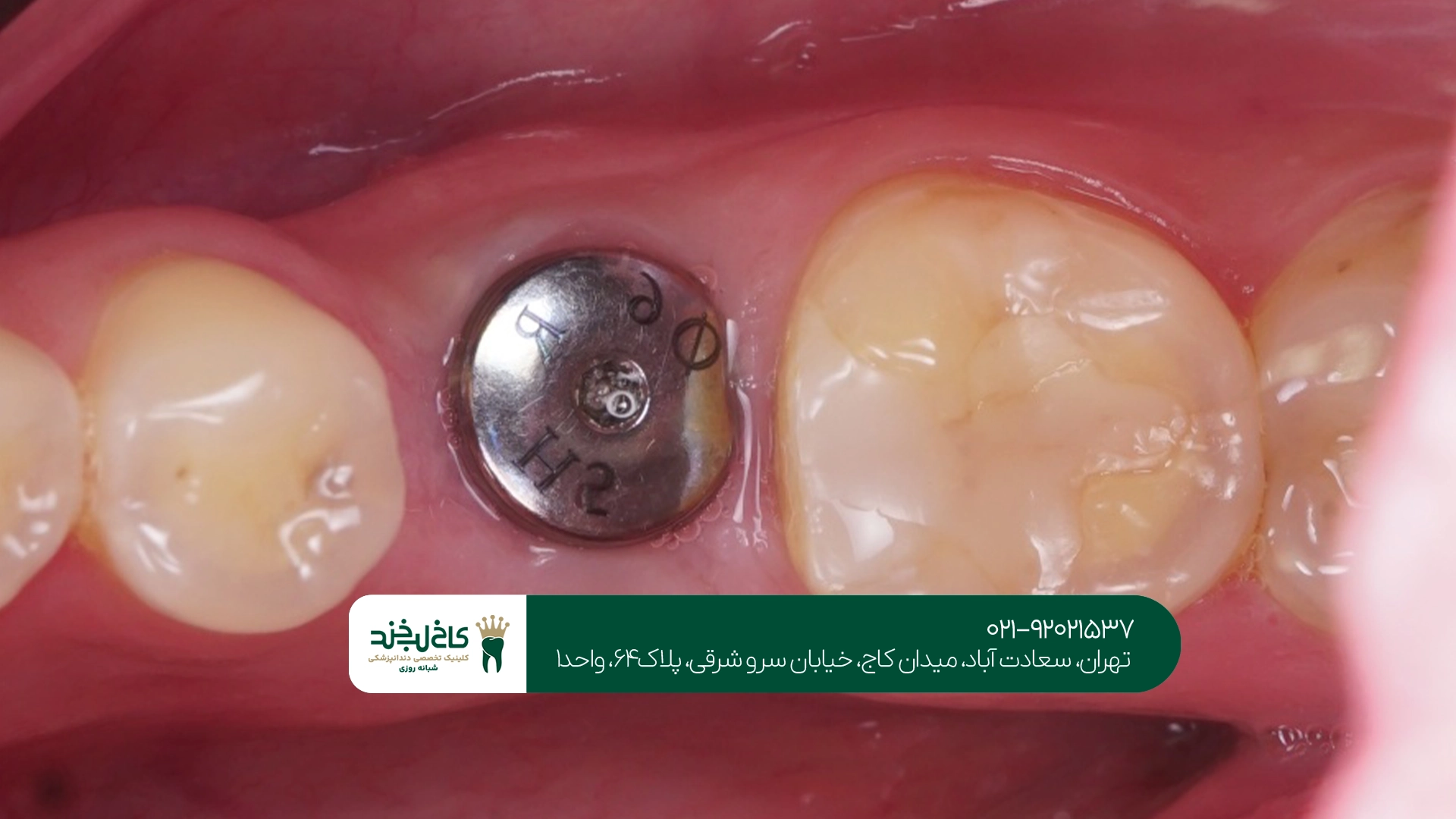 ایمپلنت دندان ایمپلنت دندان