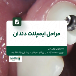 مراحل ایمپلنت دندان