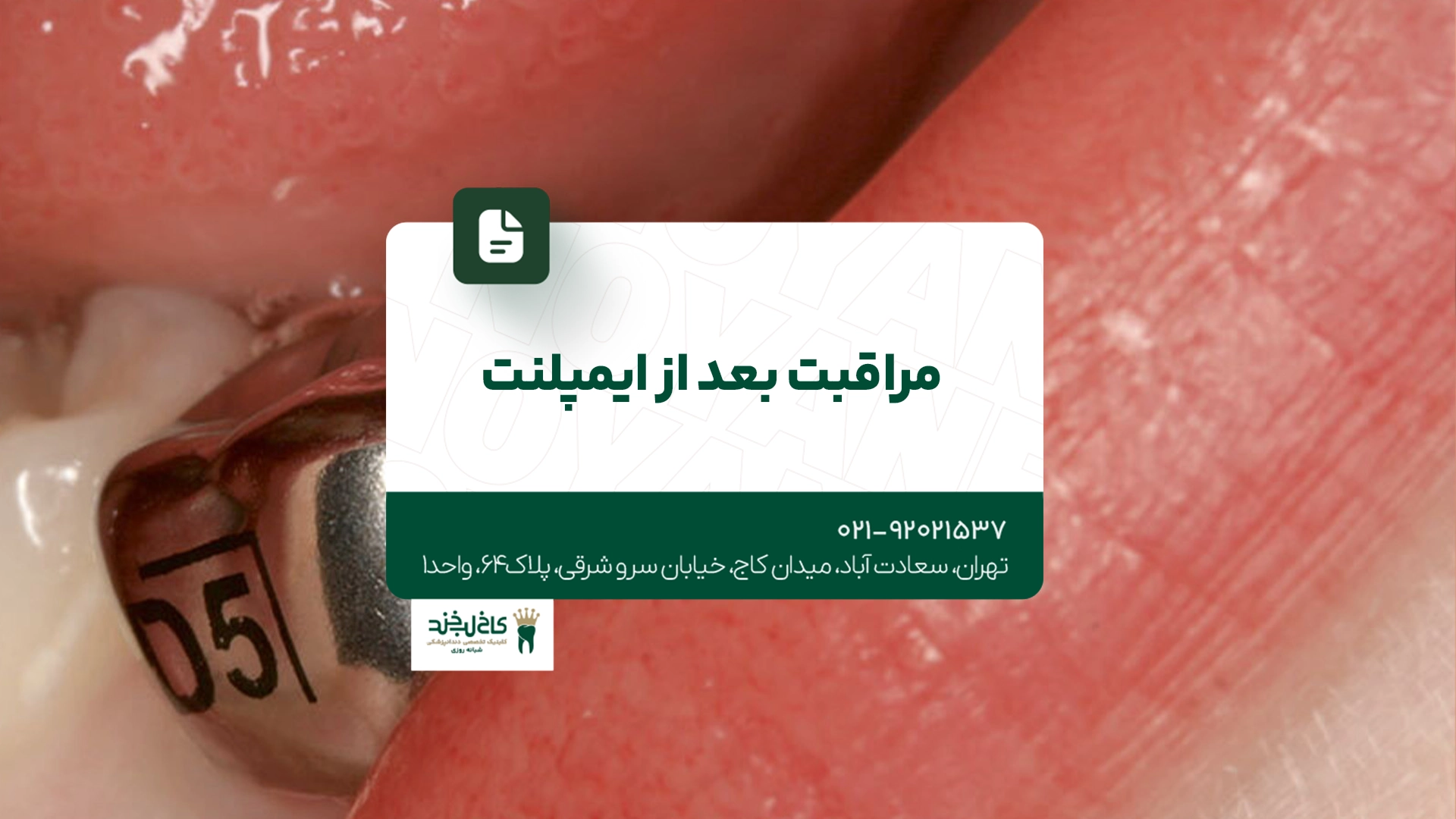 مراقبت بعد از ایمپلنت