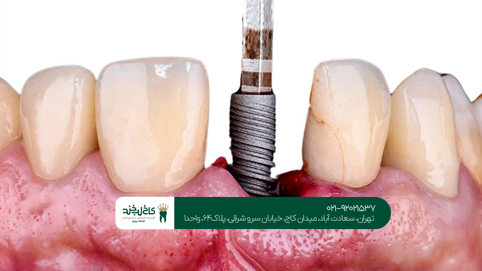 متخصص ایمپلنت دندان