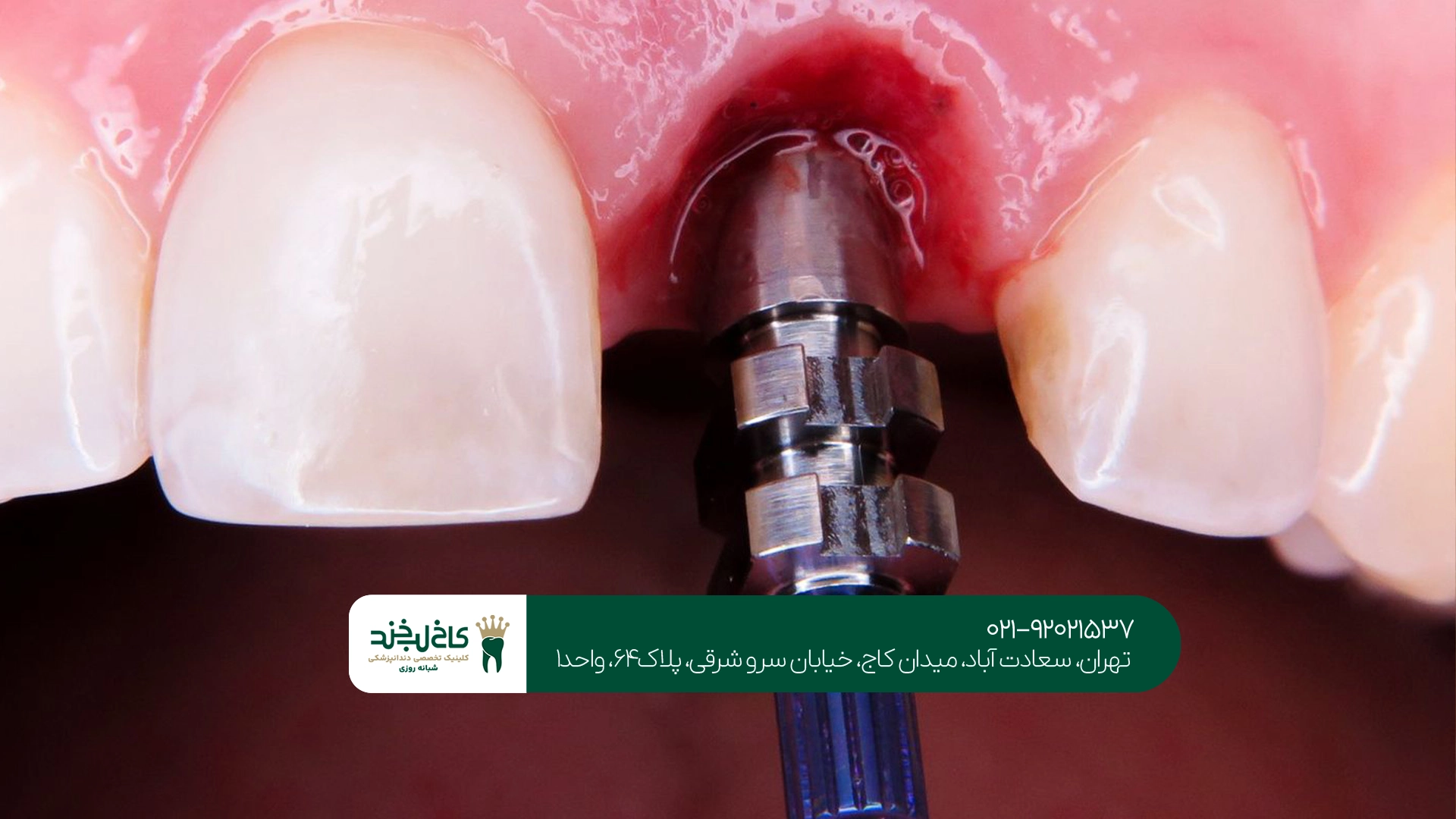 بهترین مرکز ایمپلنت دندان