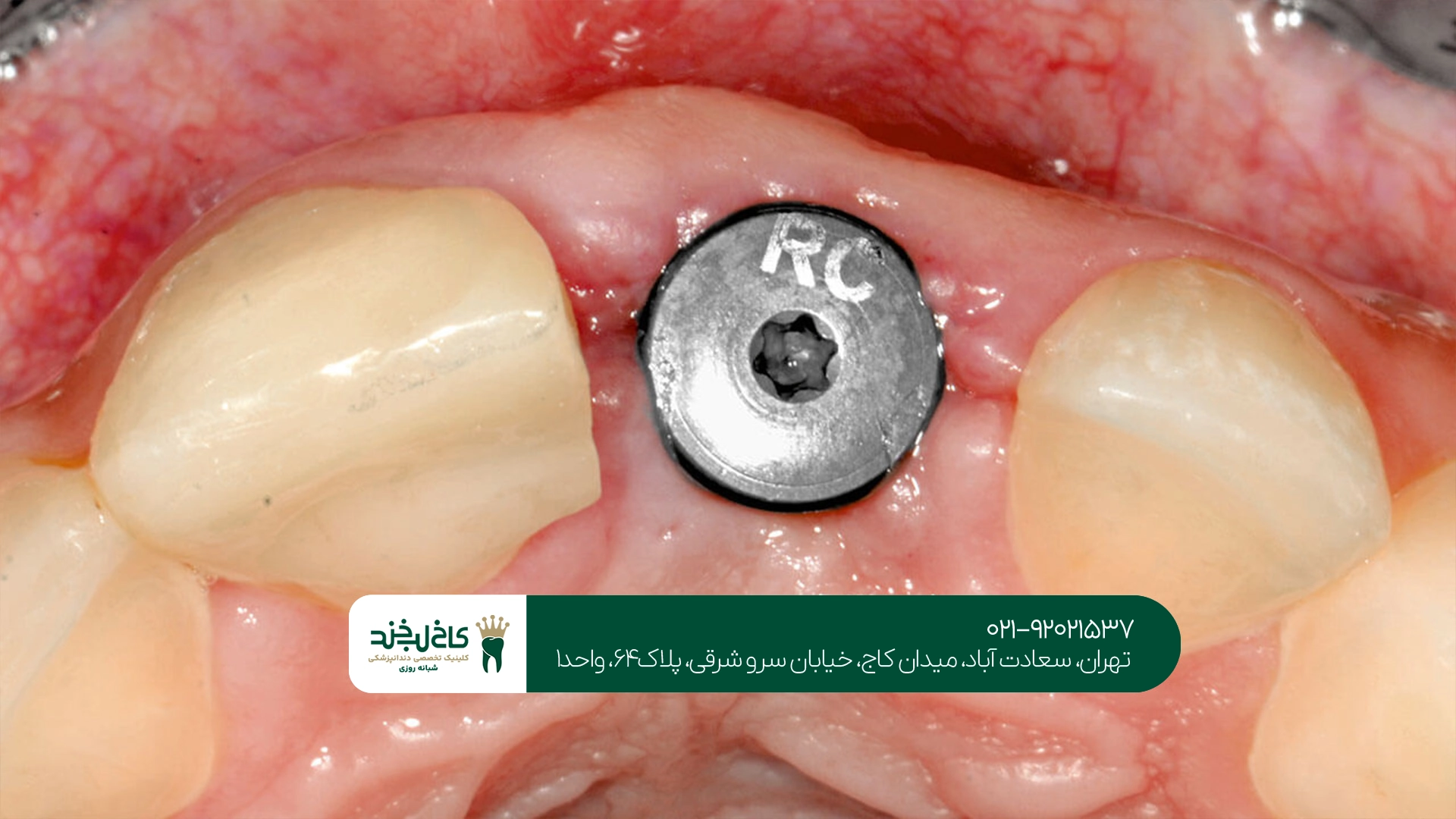 علائم طبیعی و غیرطبیعی بعد از ایمپلنت دندان