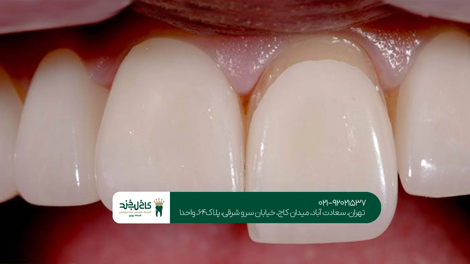 تاثیر نوشیدنی ها بر ماندگاری لمینت دندان