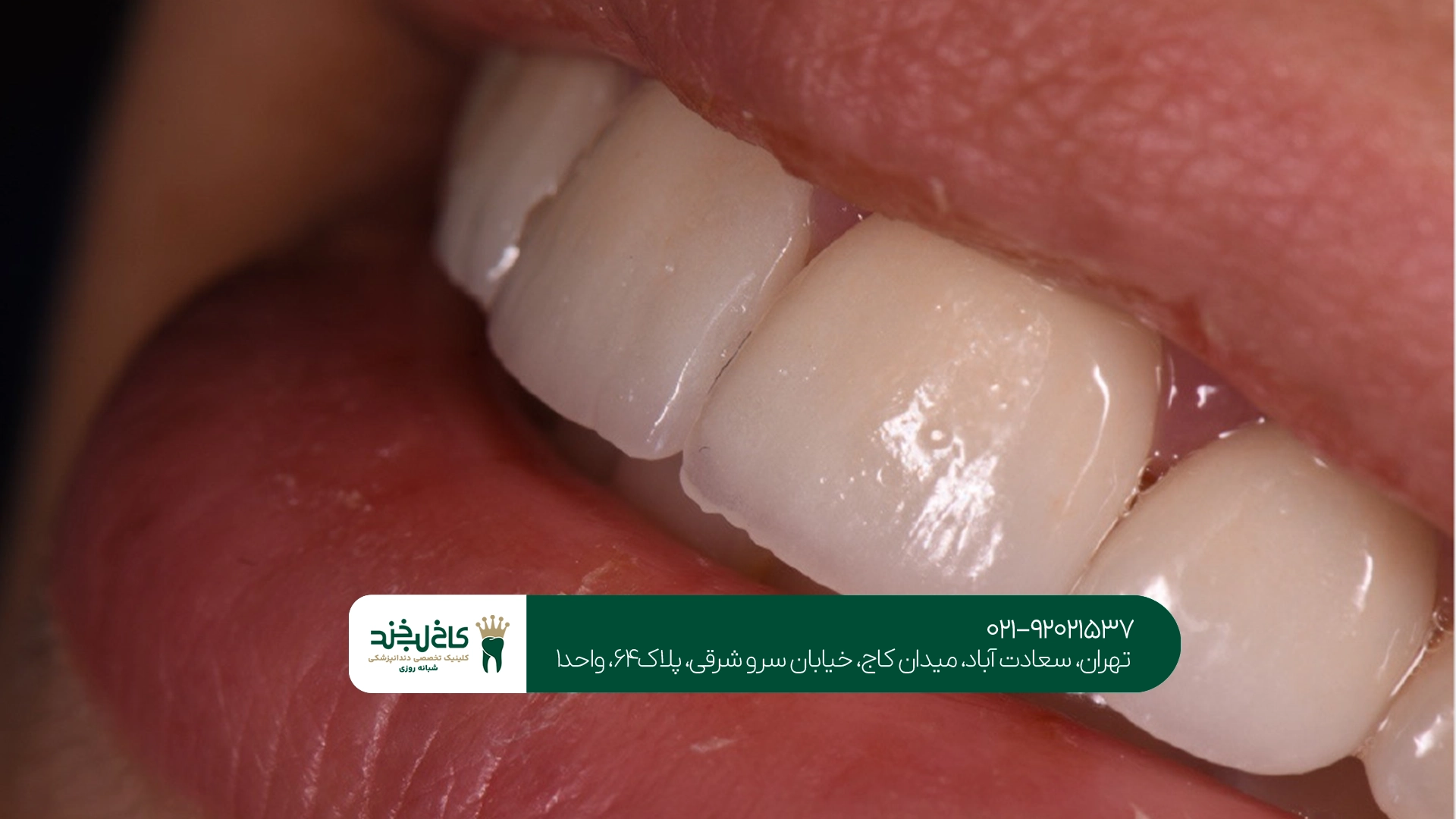 عادات غذایی مضر برای لمینت دندان