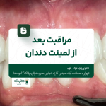 مراقبت بعد از لمینت دندان