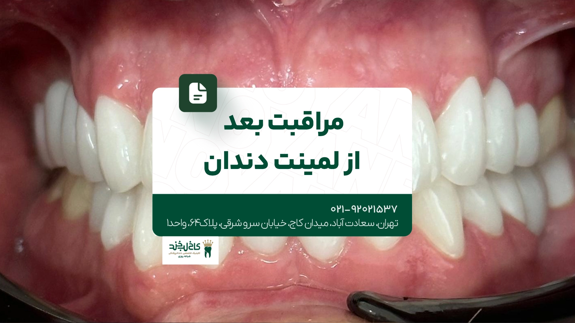 مراقبت بعد از لمینت دندان
