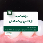 مراقبت بعد از کامپوزیت دندان