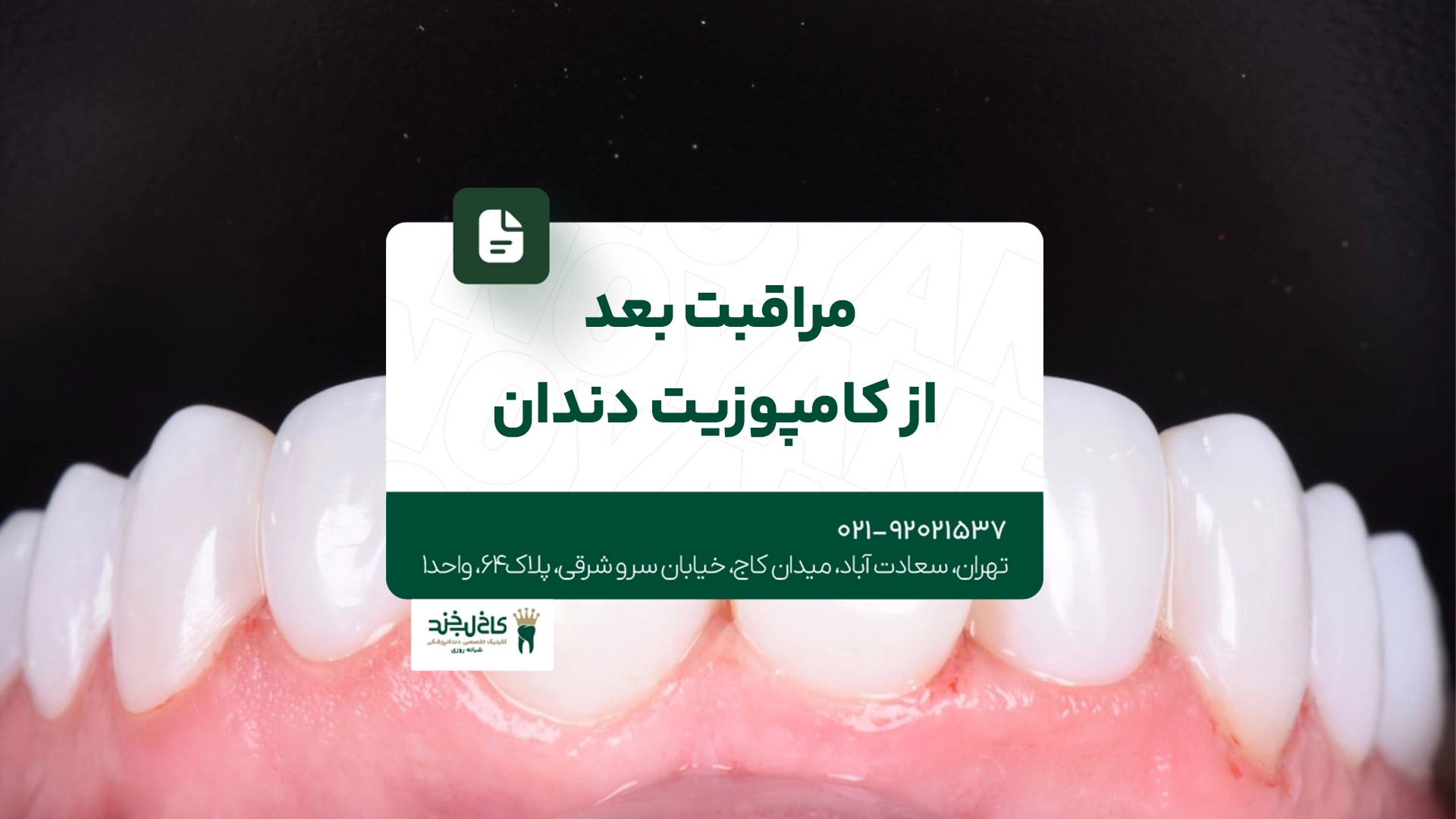 مراقبت بعد از کامپوزیت دندان مراقبت بعد از کامپوزیت دندان