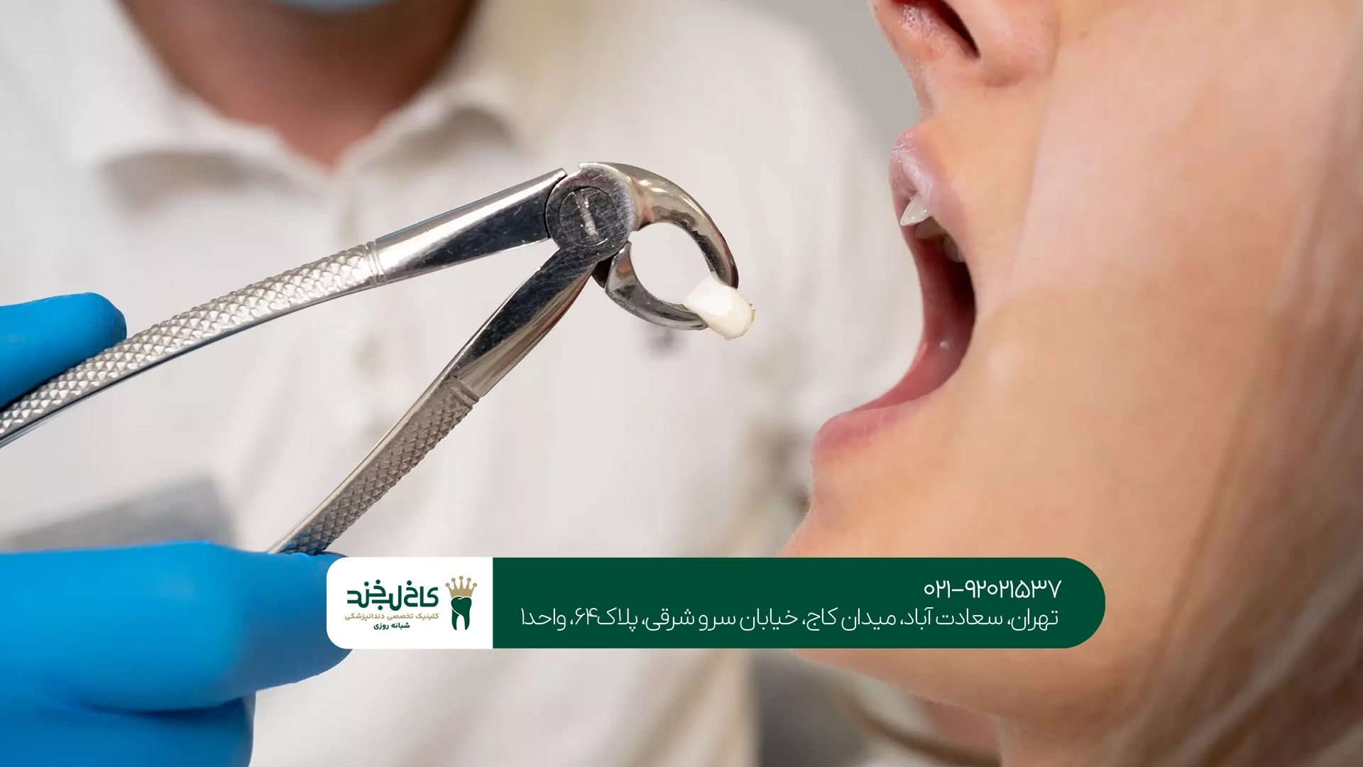 کشیدن دندان در تهران