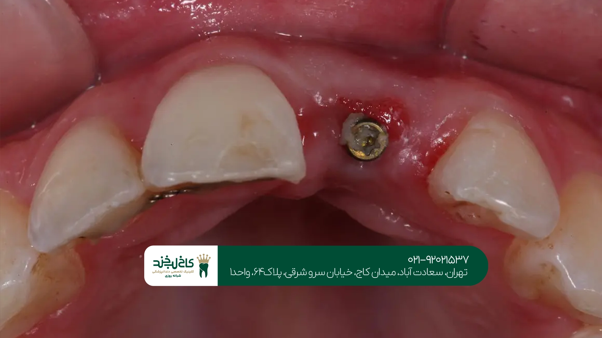 مراحل انجام ایمپلنت بدون درد در تهران مراحل انجام ایمپلنت بدون درد در تهران