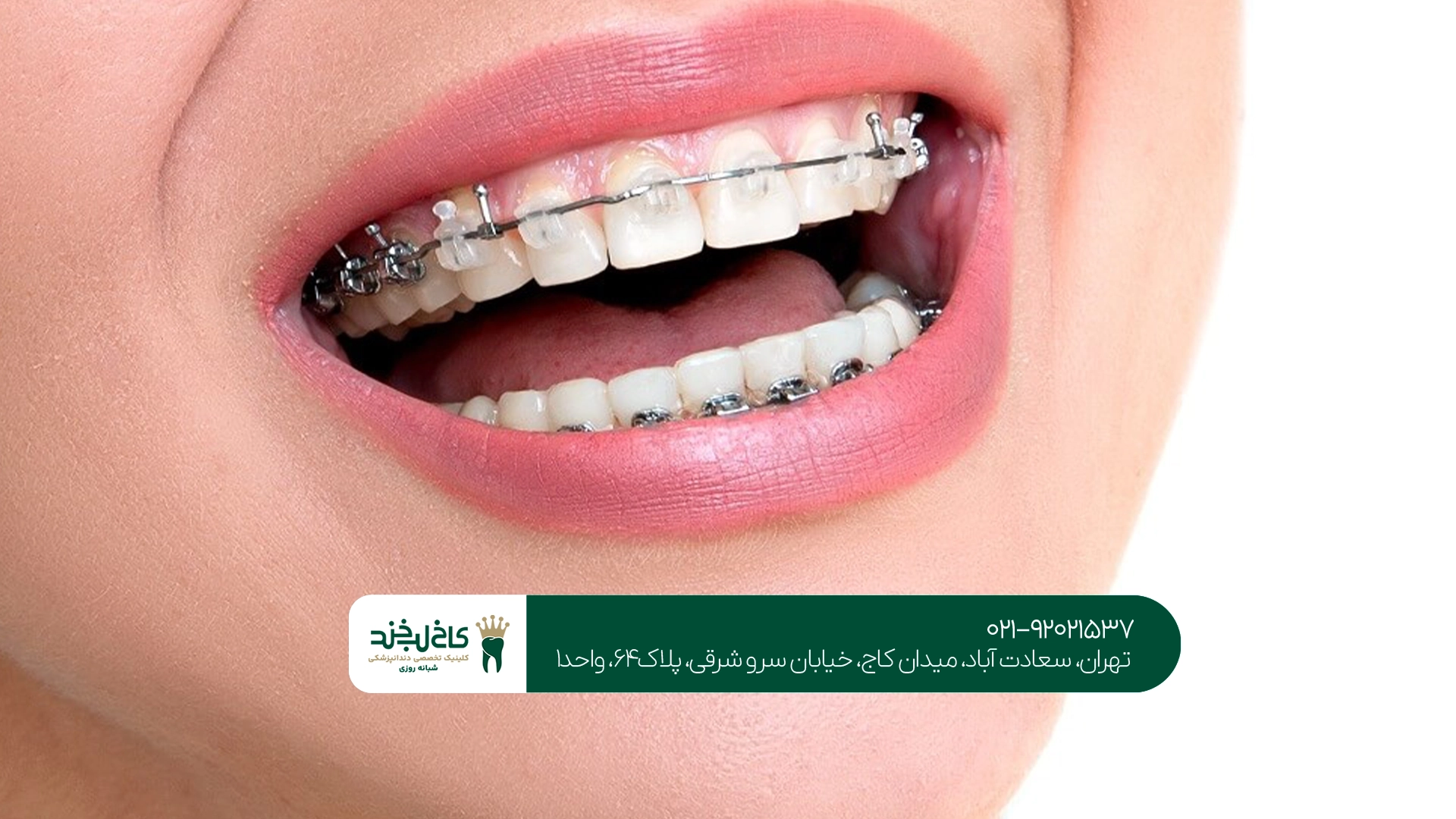 ارتودنسی دندان ارتودنسی دندان