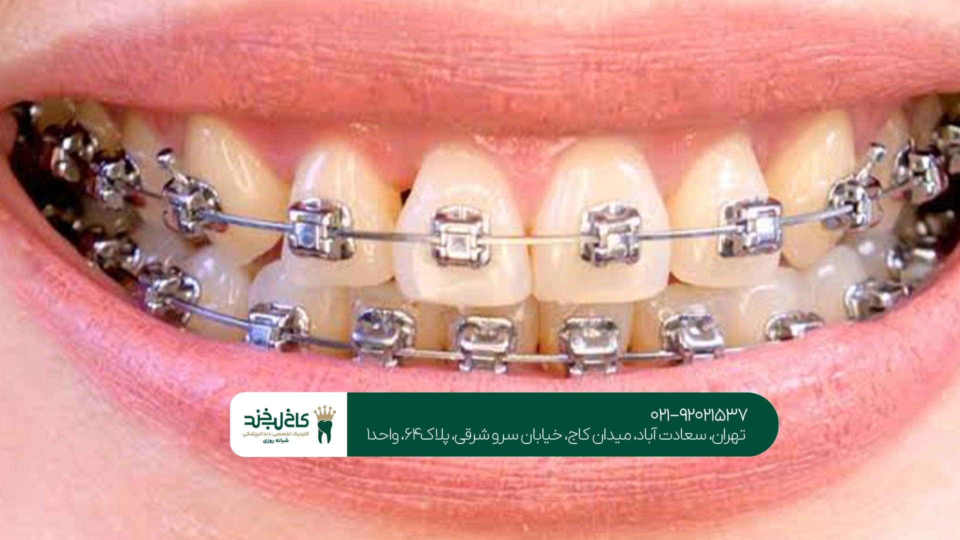 ارتودنسی دندان در تهران ارتودنسی دندان در تهران