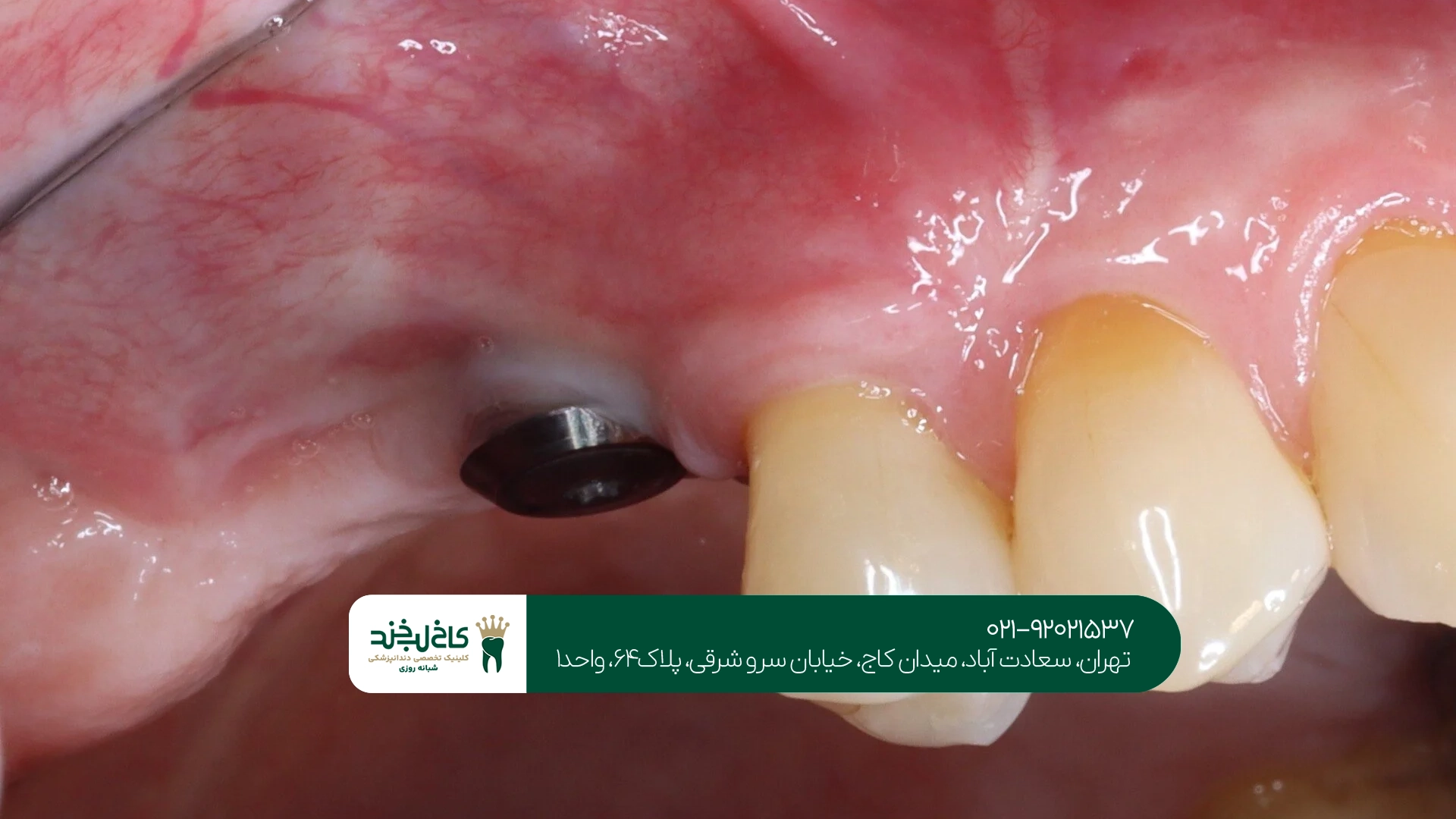 آیا هزینه ایمپلنت دندان ثابت است یا متغیر؟