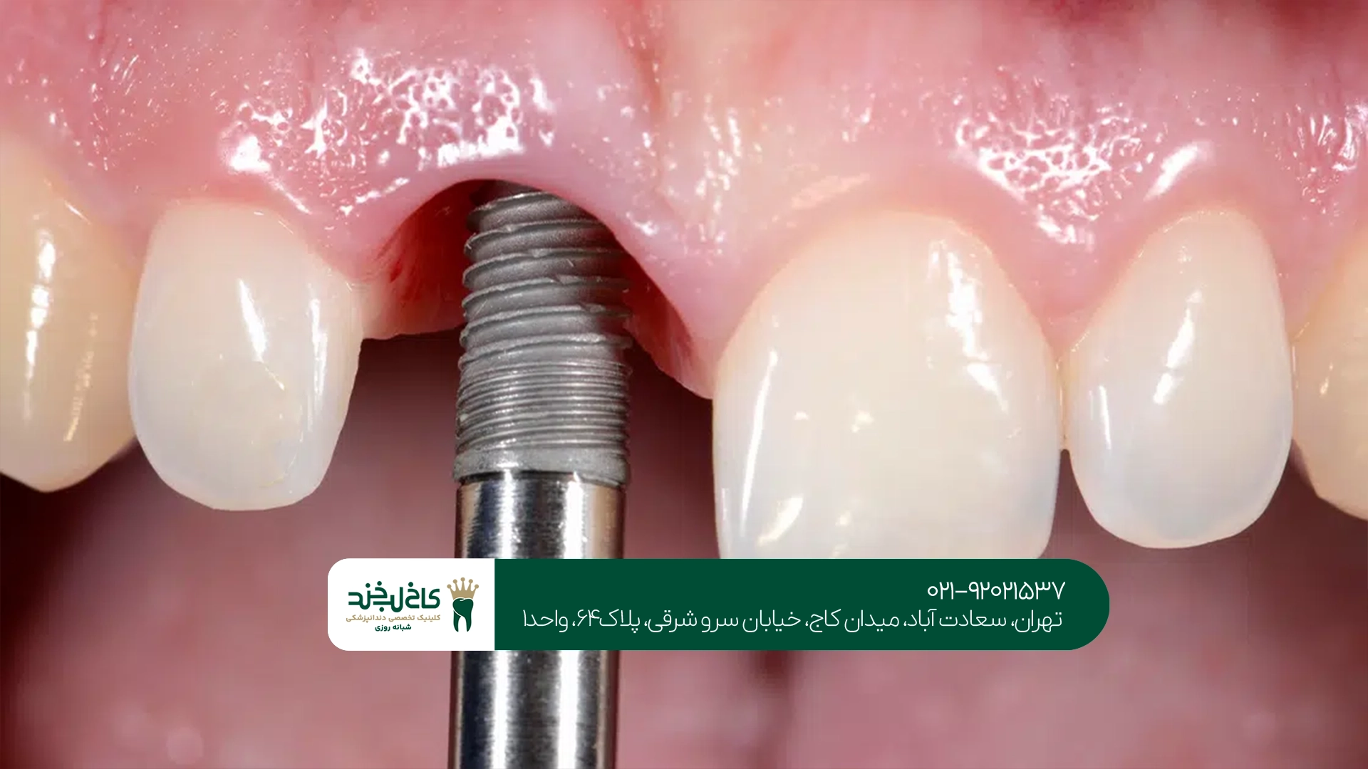 آیا ایمپلنت دندان ارزش هزینه کردن دارد؟