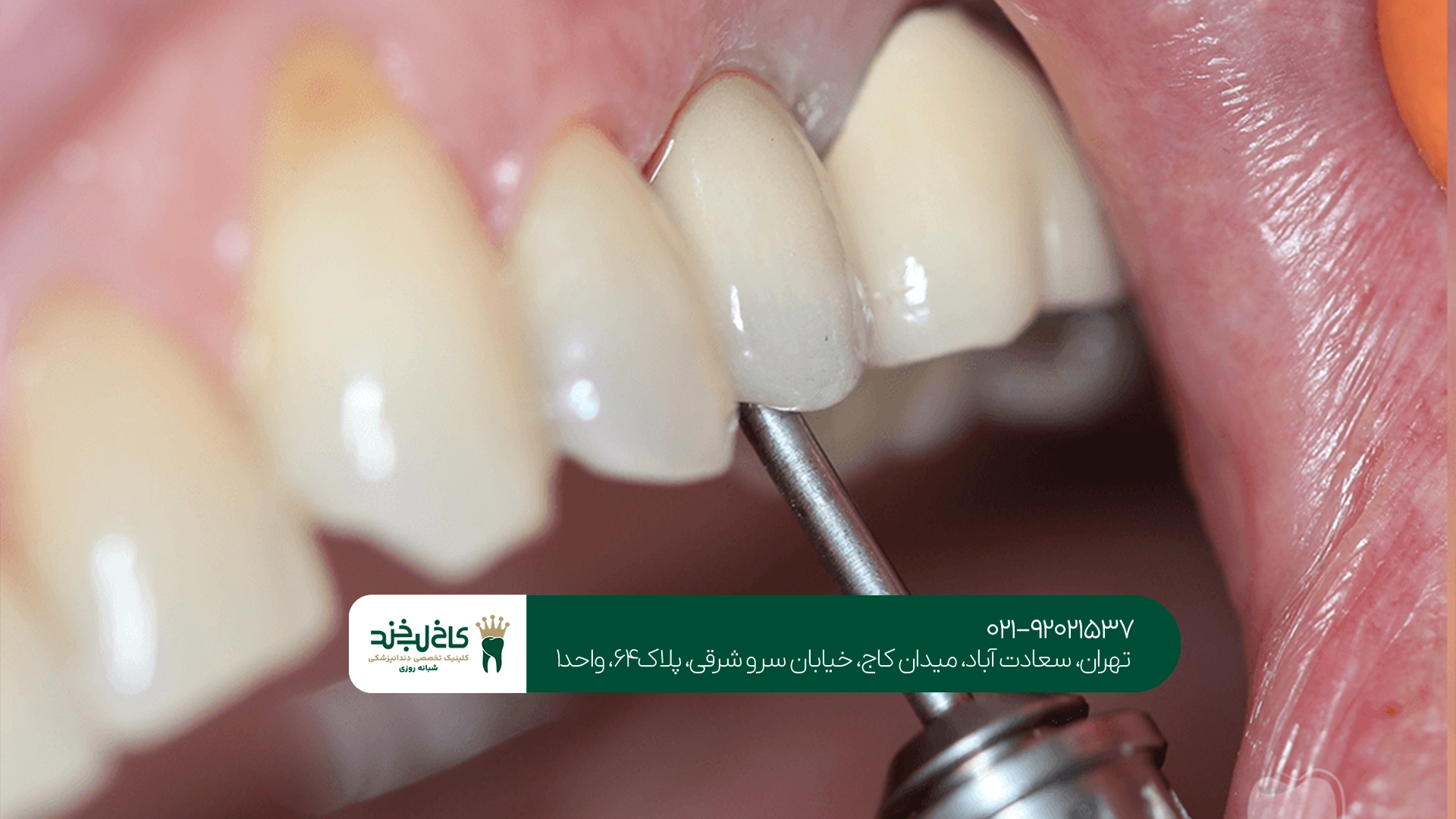 متخصص ایمپلنت دندان