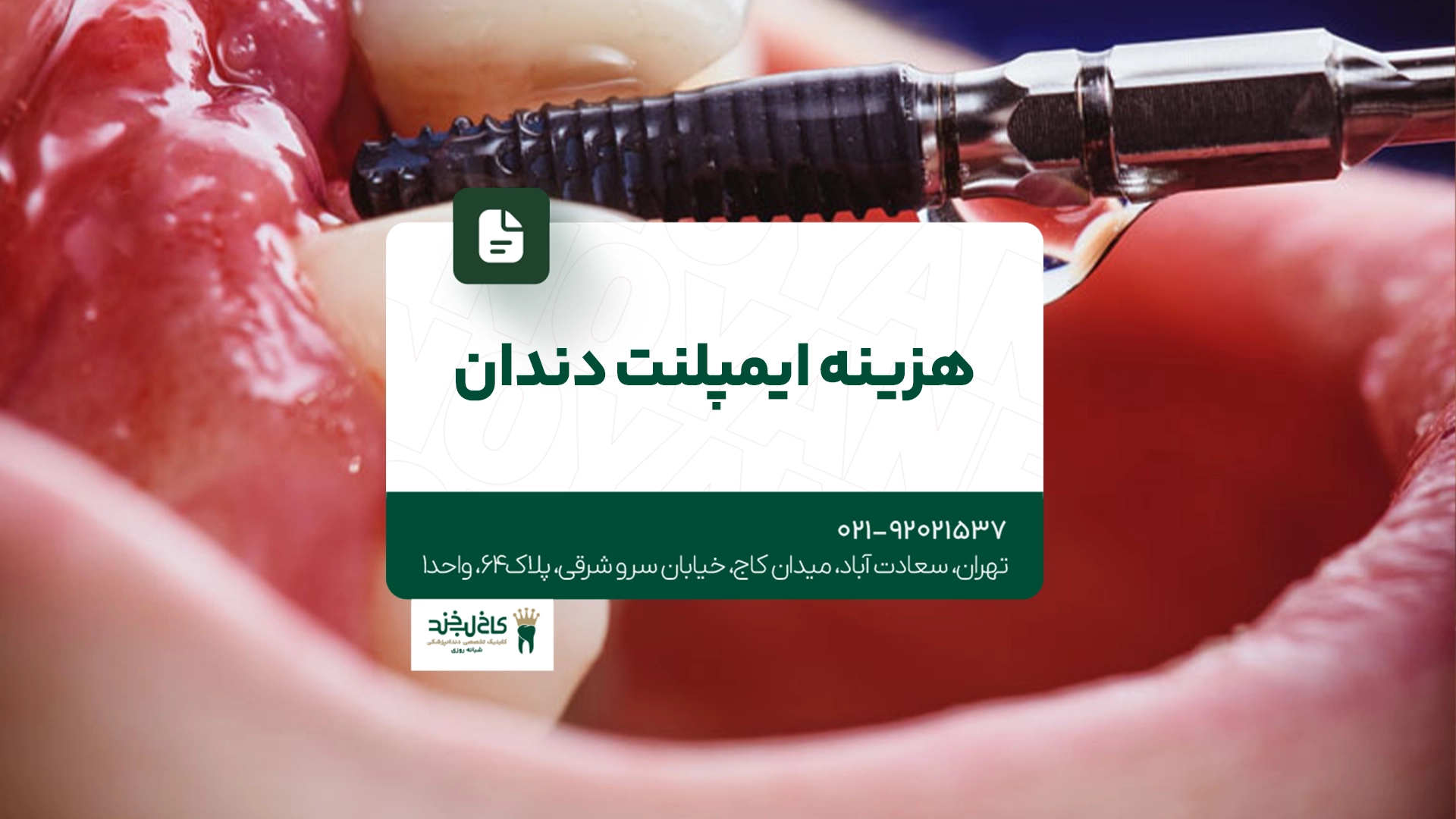 هزینه ایمپلنت دندان