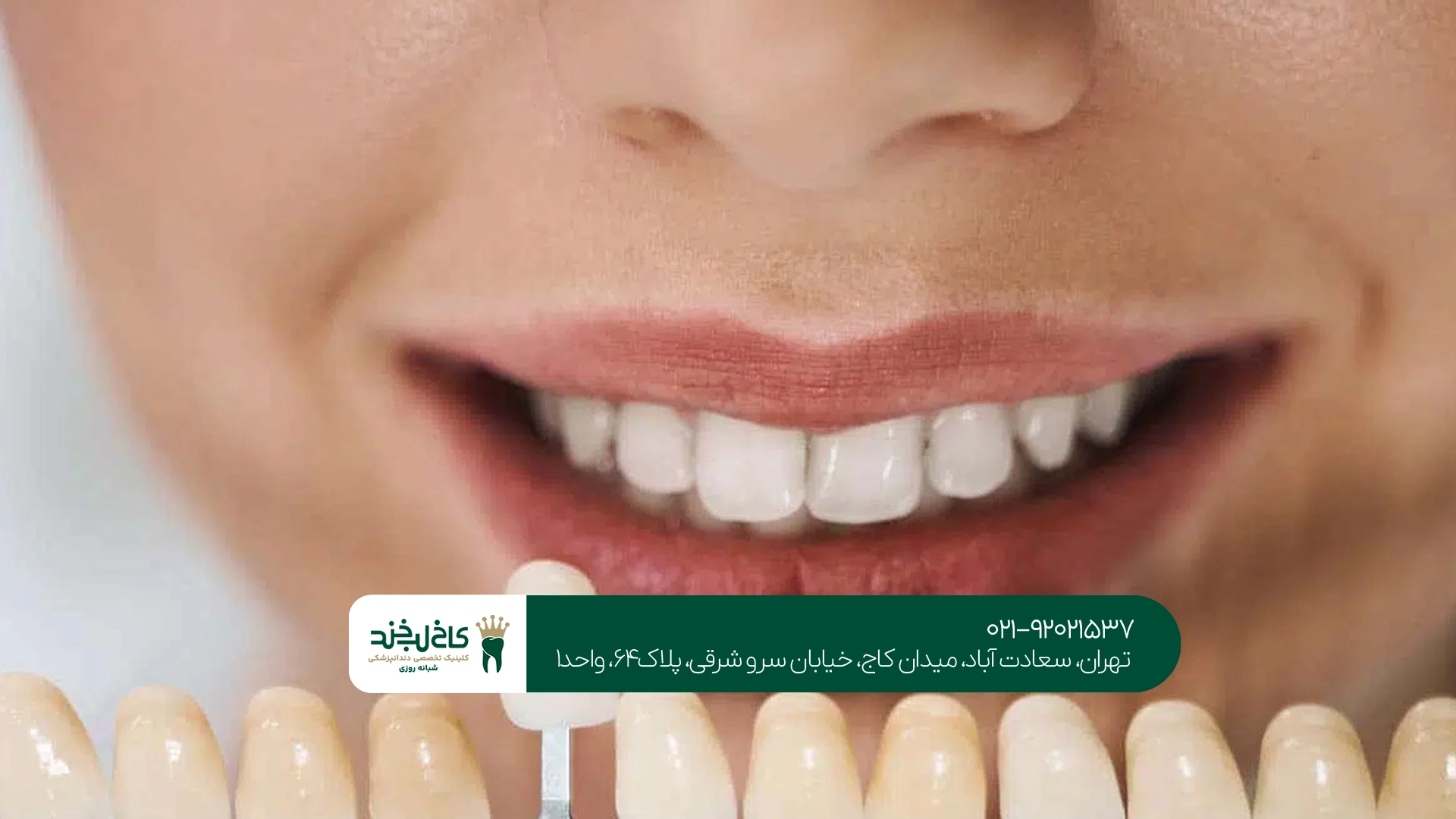کامپوزیت ونیر در کلینیک تخصصی