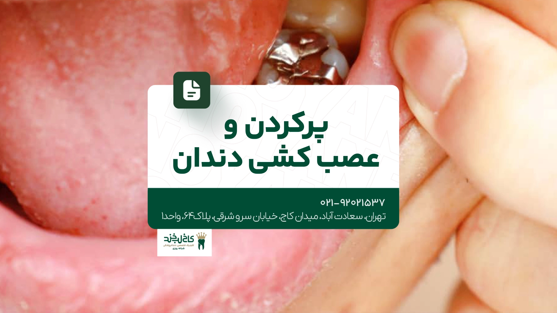 پر کردن و عصب کشی دندان پر کردن و عصب کشی دندان