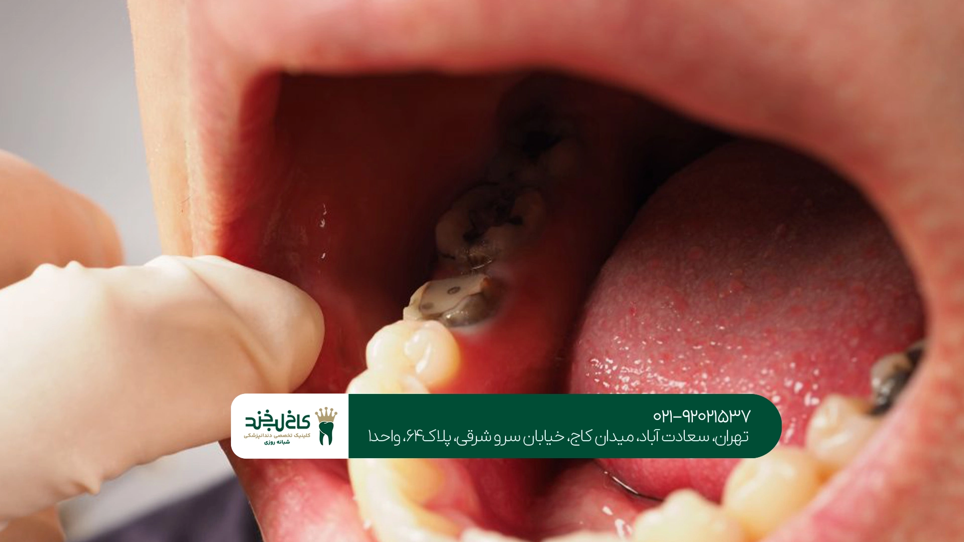 عصب کشی دندان در تهران عصب کشی دندان در تهران