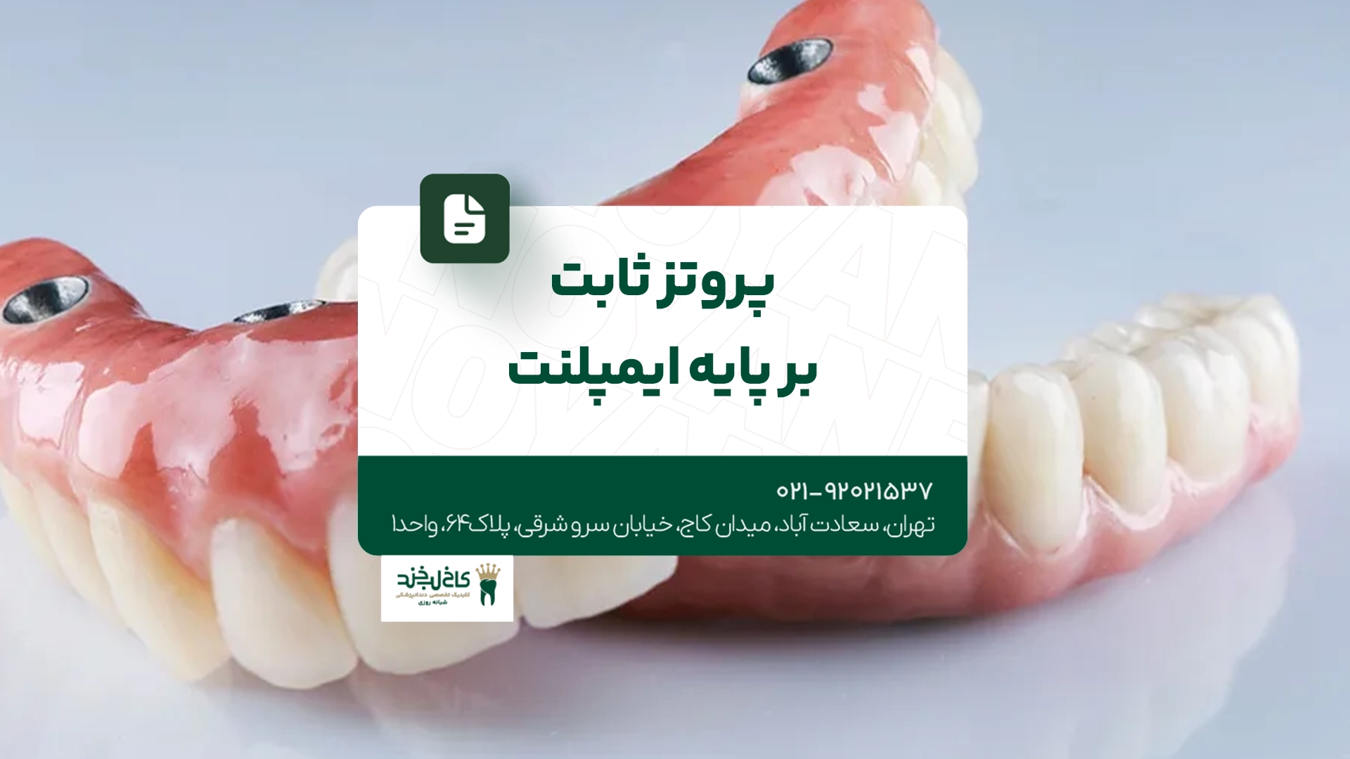 پروتز ثابت بر پایه ایمپلنت پروتز ثابت بر پایه ایمپلنت