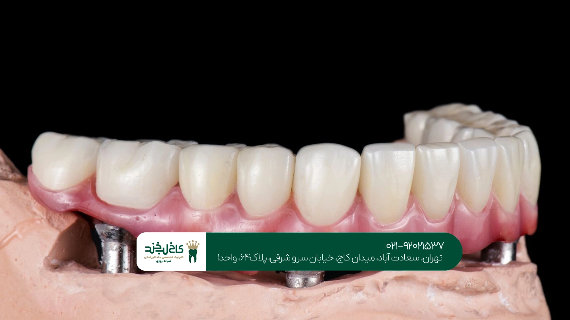بهترین مرکز پروتز ثابت بر پایه ایمپلنت بهترین مرکز پروتز ثابت بر پایه ایمپلنت