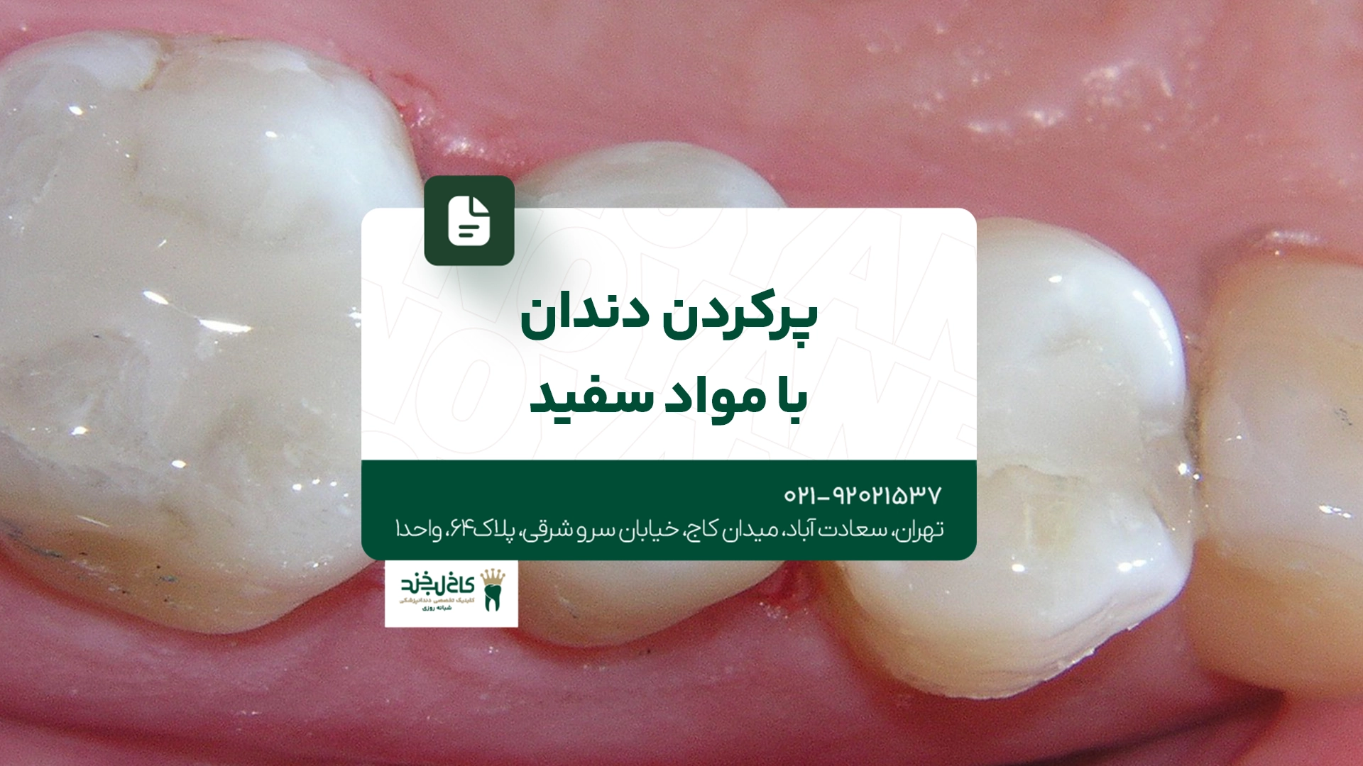 پر کردن دندان با مواد سفید