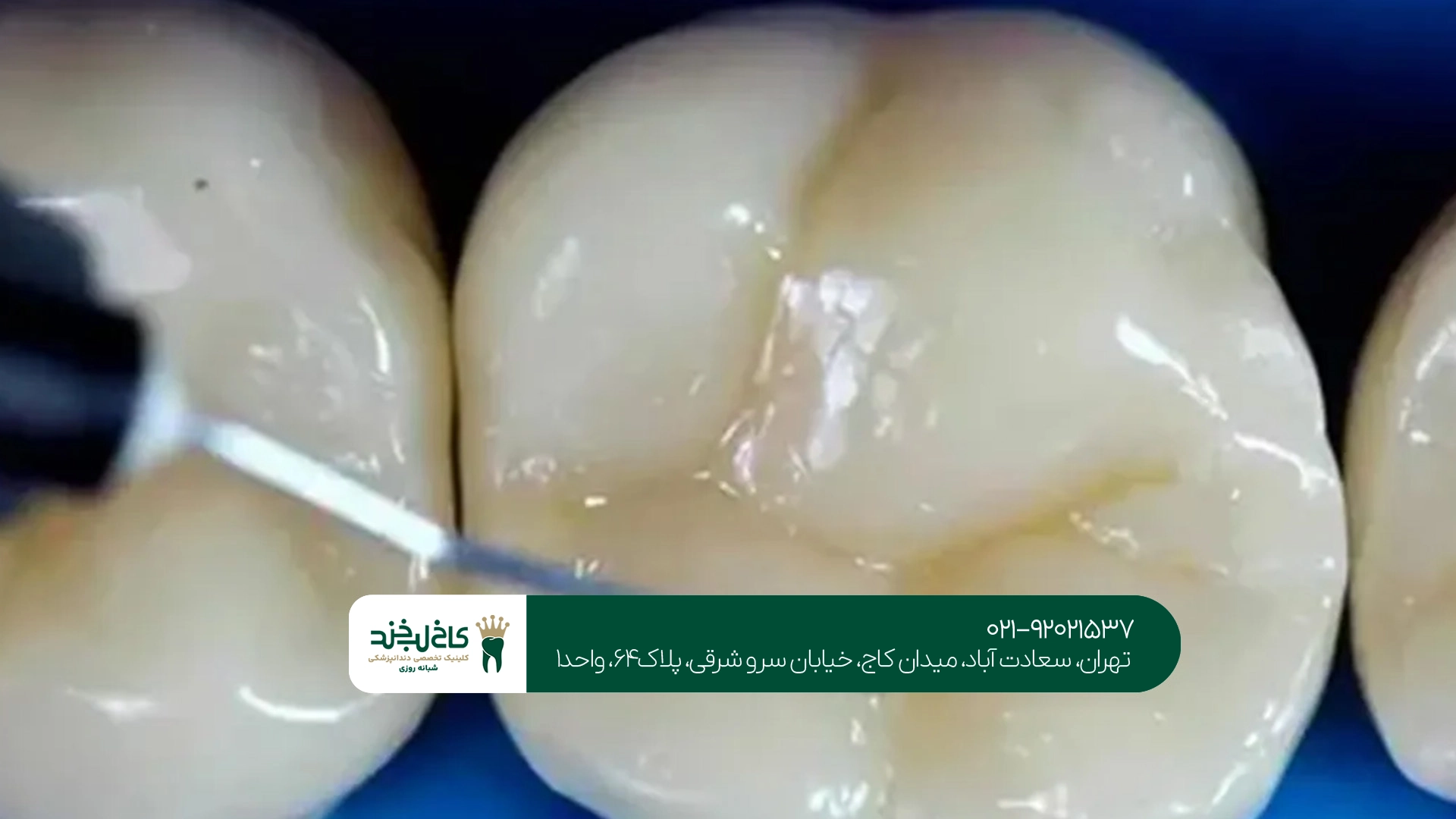 پر کردن دندان با مواد سفید برای چه دندانهایی مناسب است؟