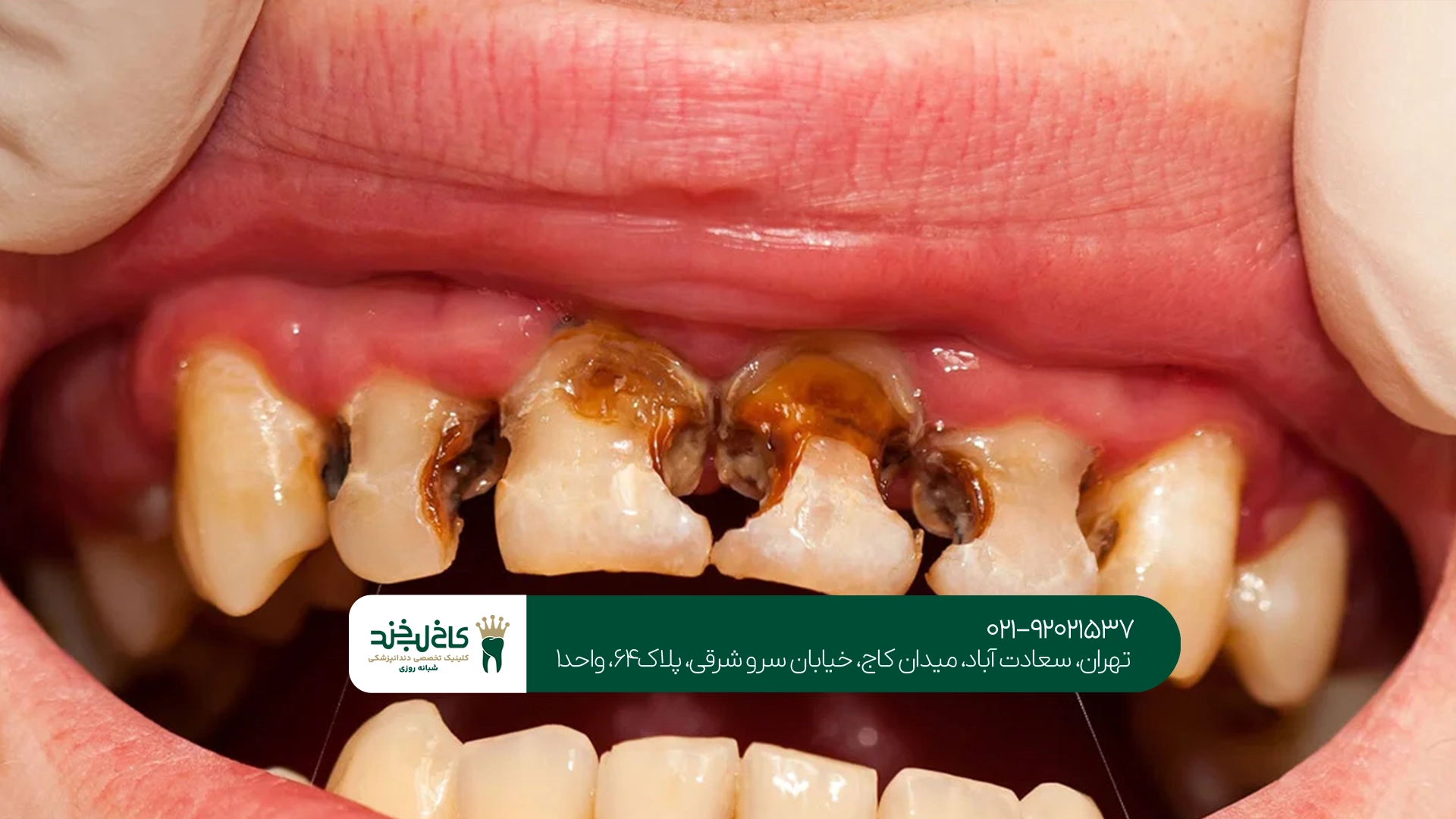 ترمیم دندان جلوی پوسیده با مواد همرنگ دندان