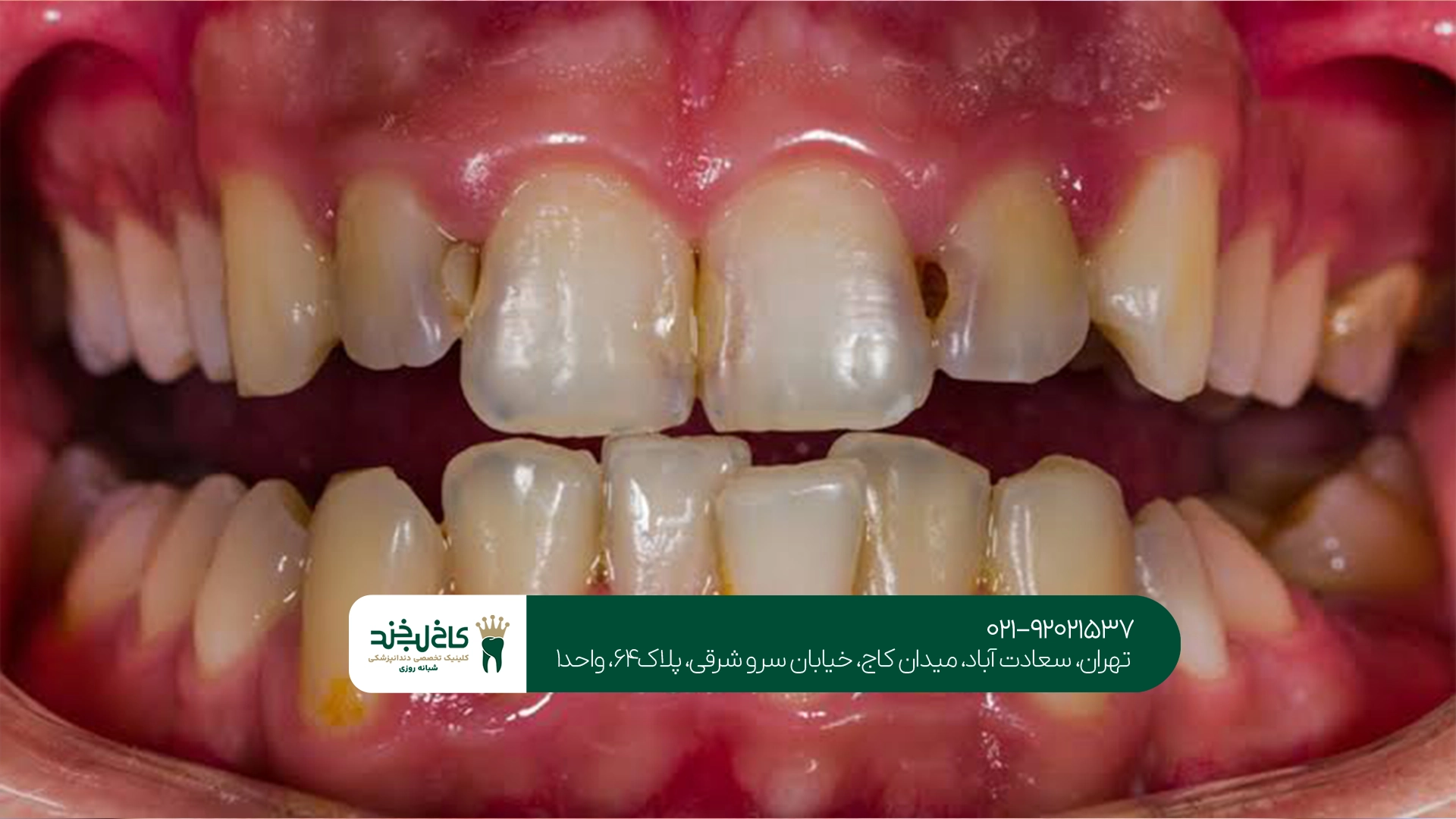 عوارض درمان نکردن پوسیدگی دندان جلو