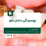 پوسیدگی دندان جلو