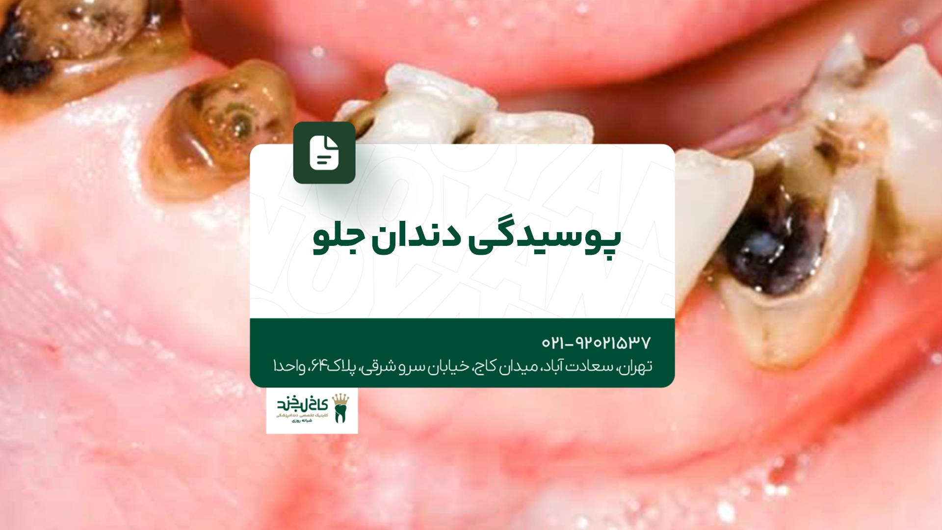پوسیدگی دندان جلو