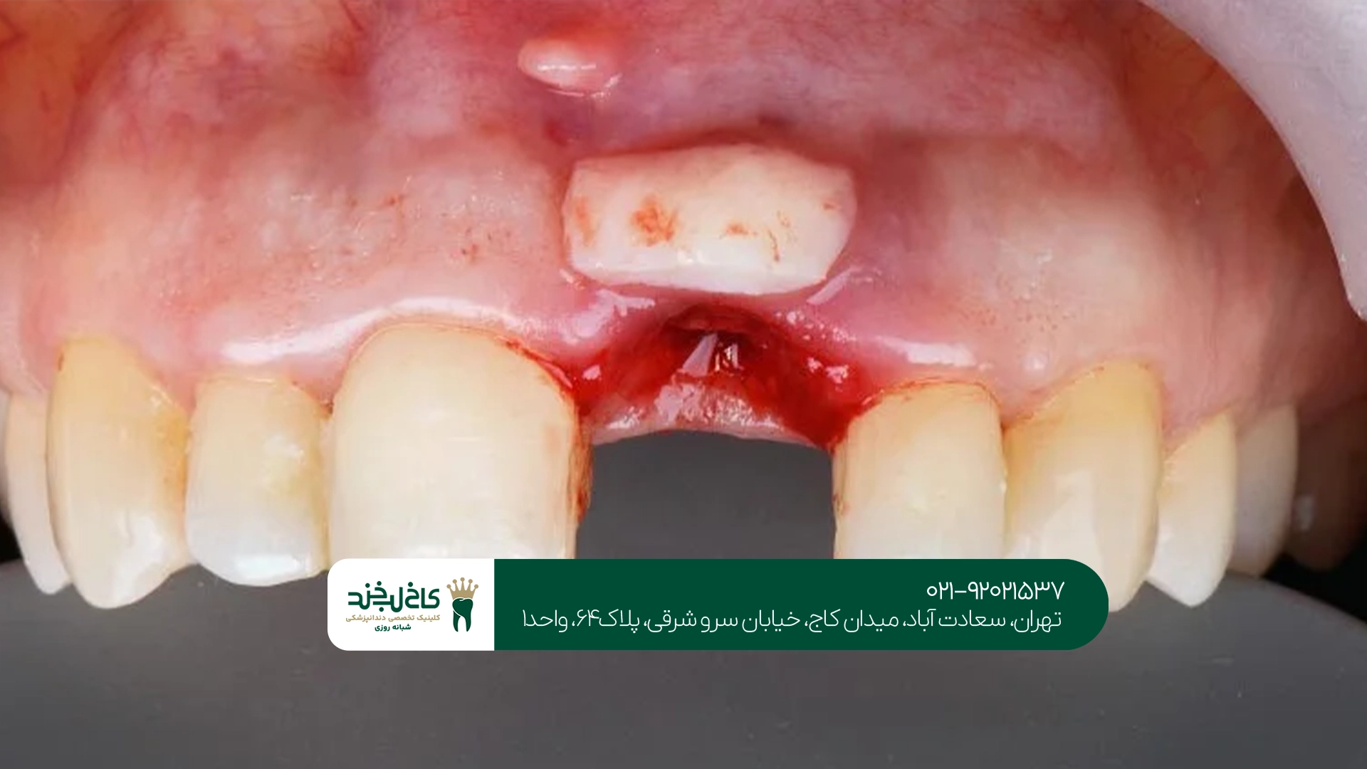 مراقبتهای ضروری بعد از پیوند لثه