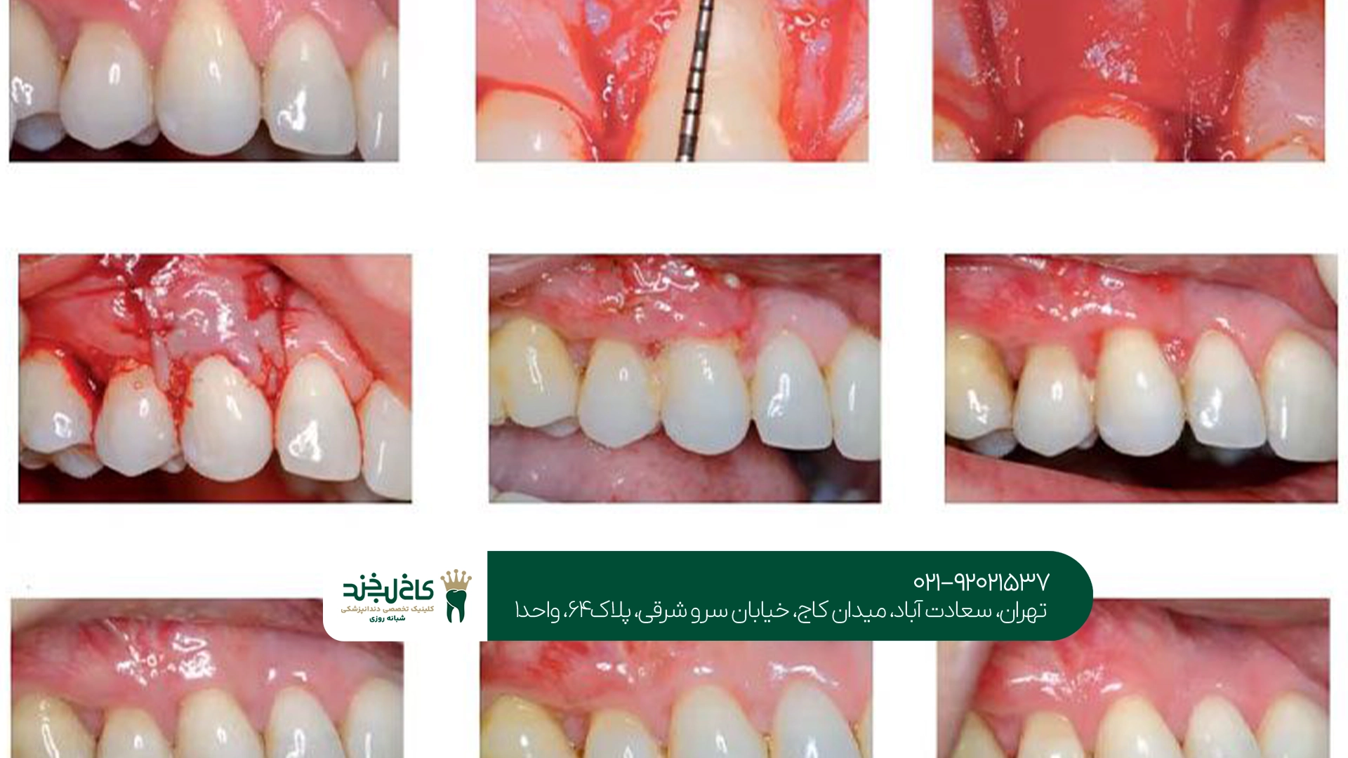 بهترین مرکز پیوند لثه در تهران