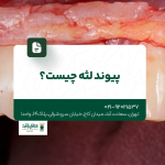 پیوند لثه چیست