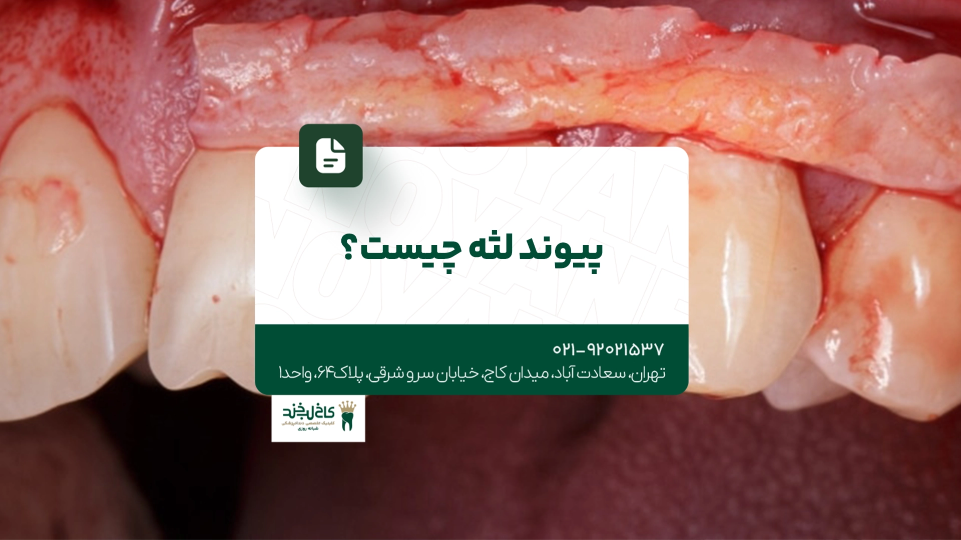 پیوند لثه چیست