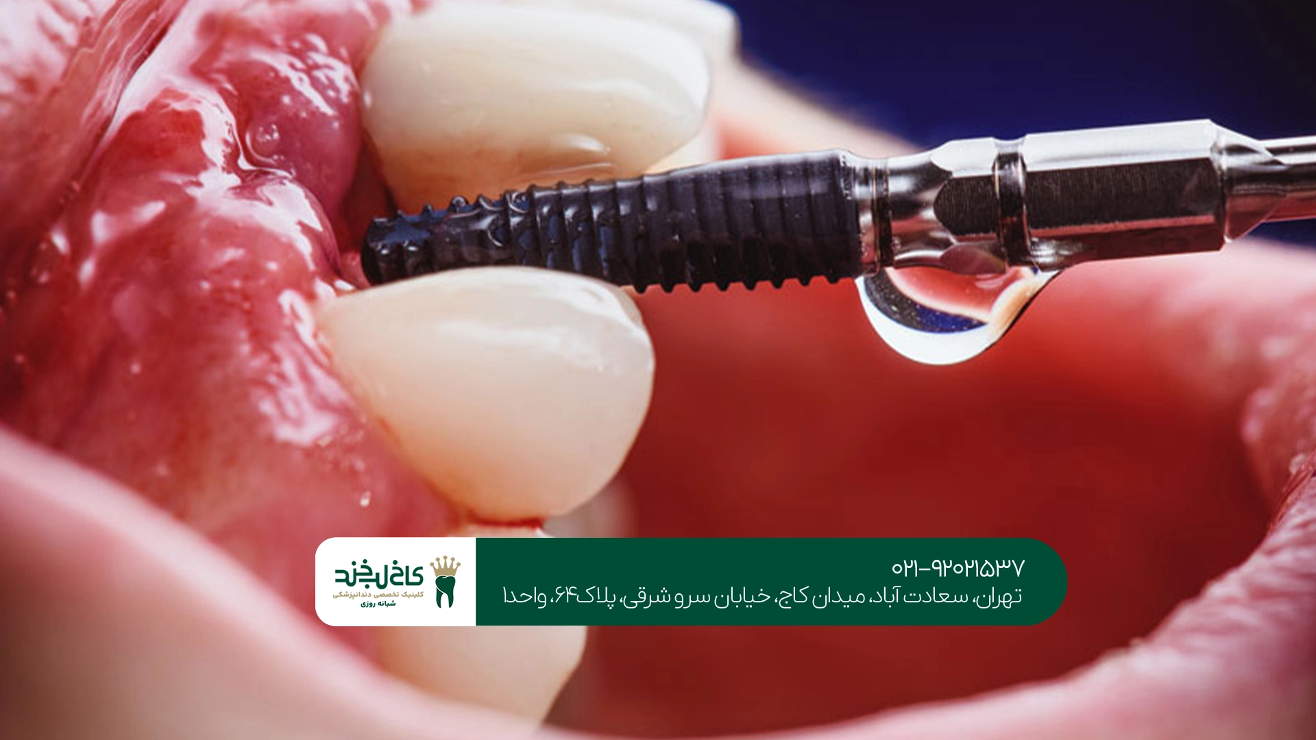 متخصص ایمپلنت دندان