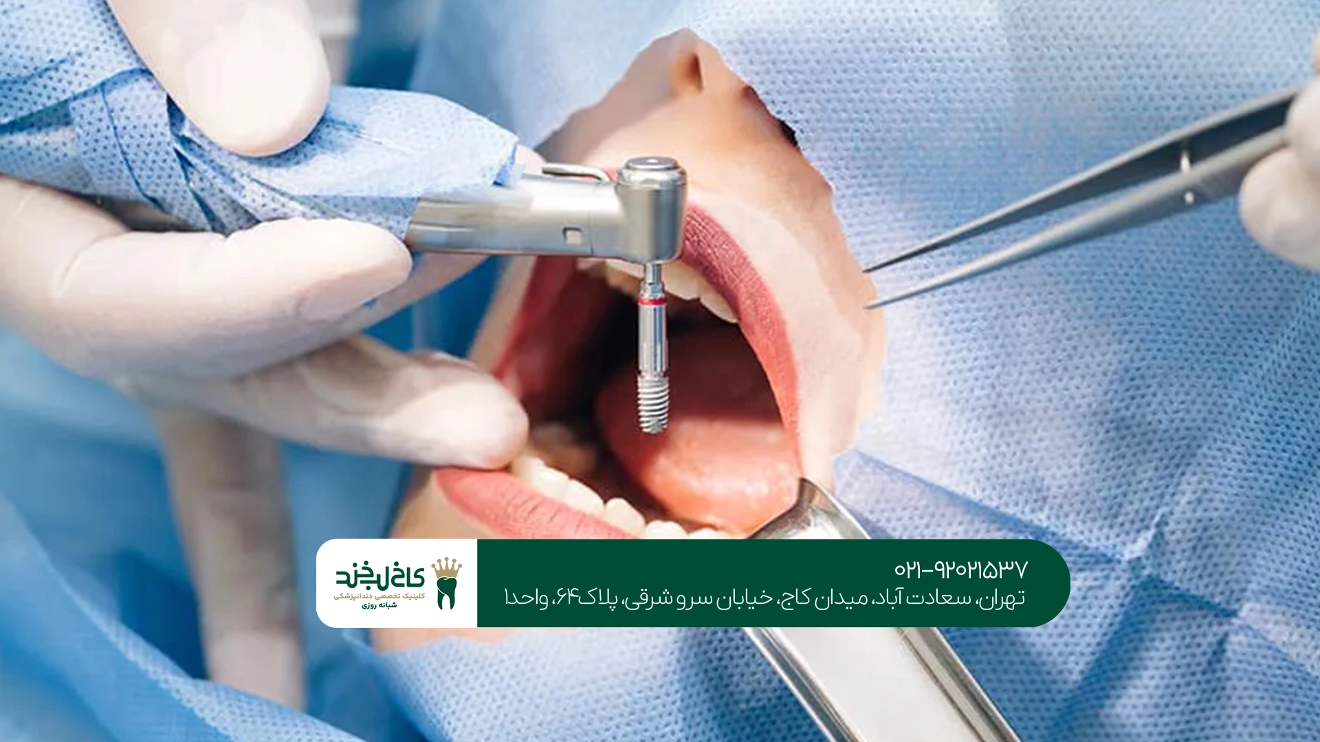 آیا سیگار کشیدن مانع انجام ایمپلنت میشود؟