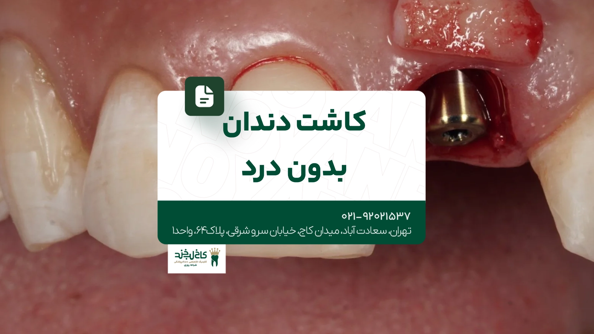 کاشت دندان بدون درد کاشت دندان بدون درد