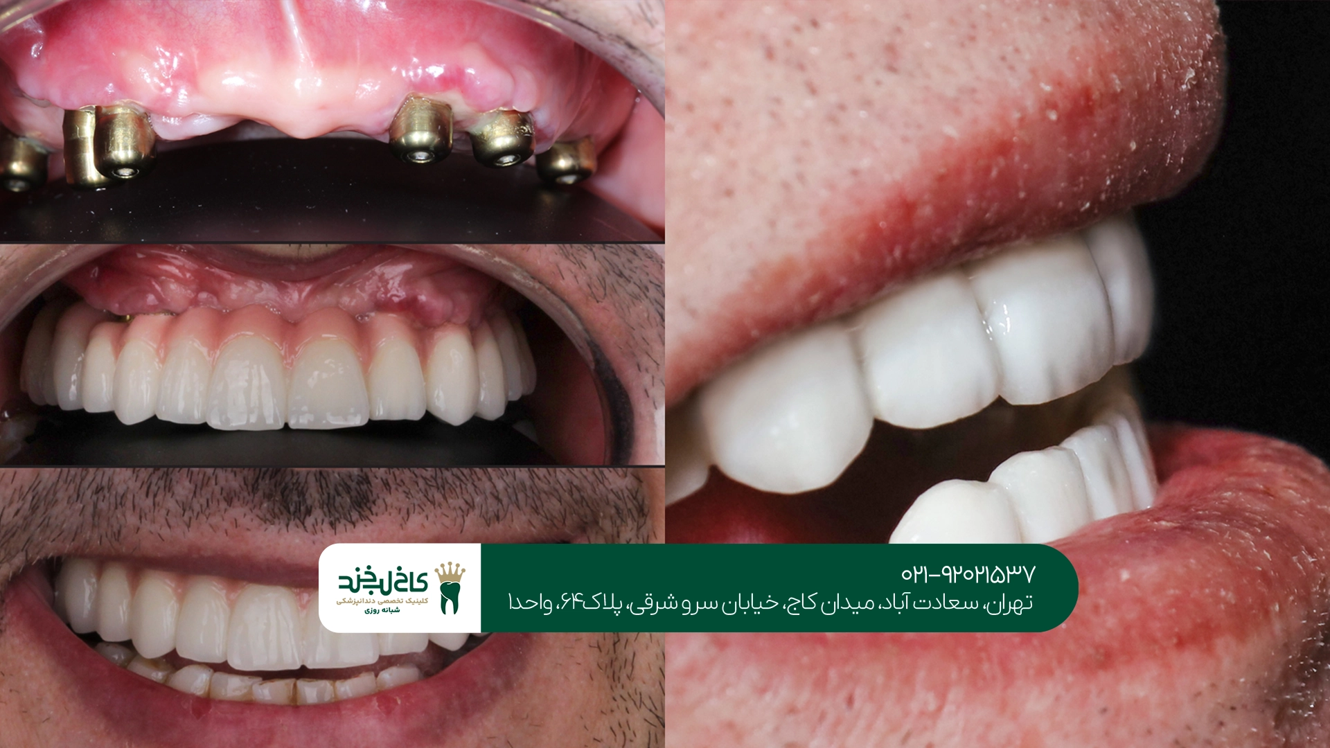 کاشت دندان در تهران کاشت دندان در تهران