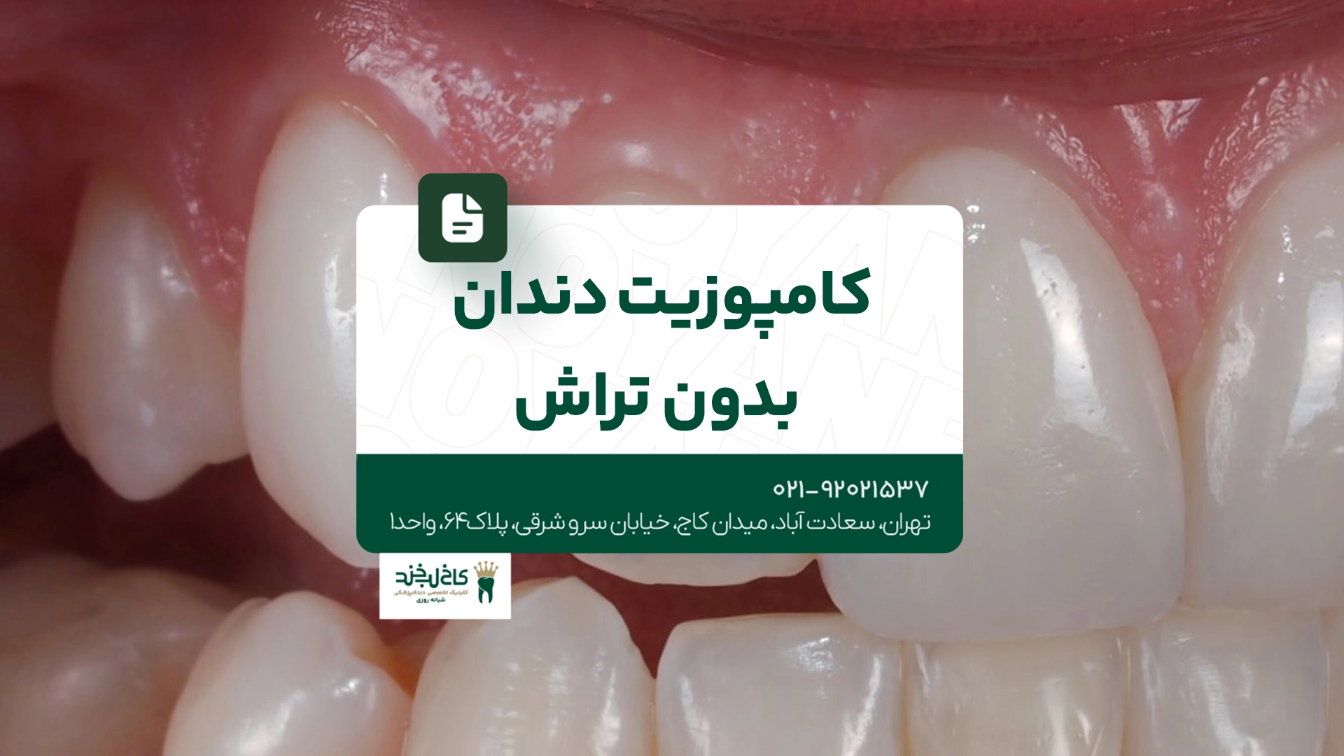 کامپوزیت دندان بدون تراش