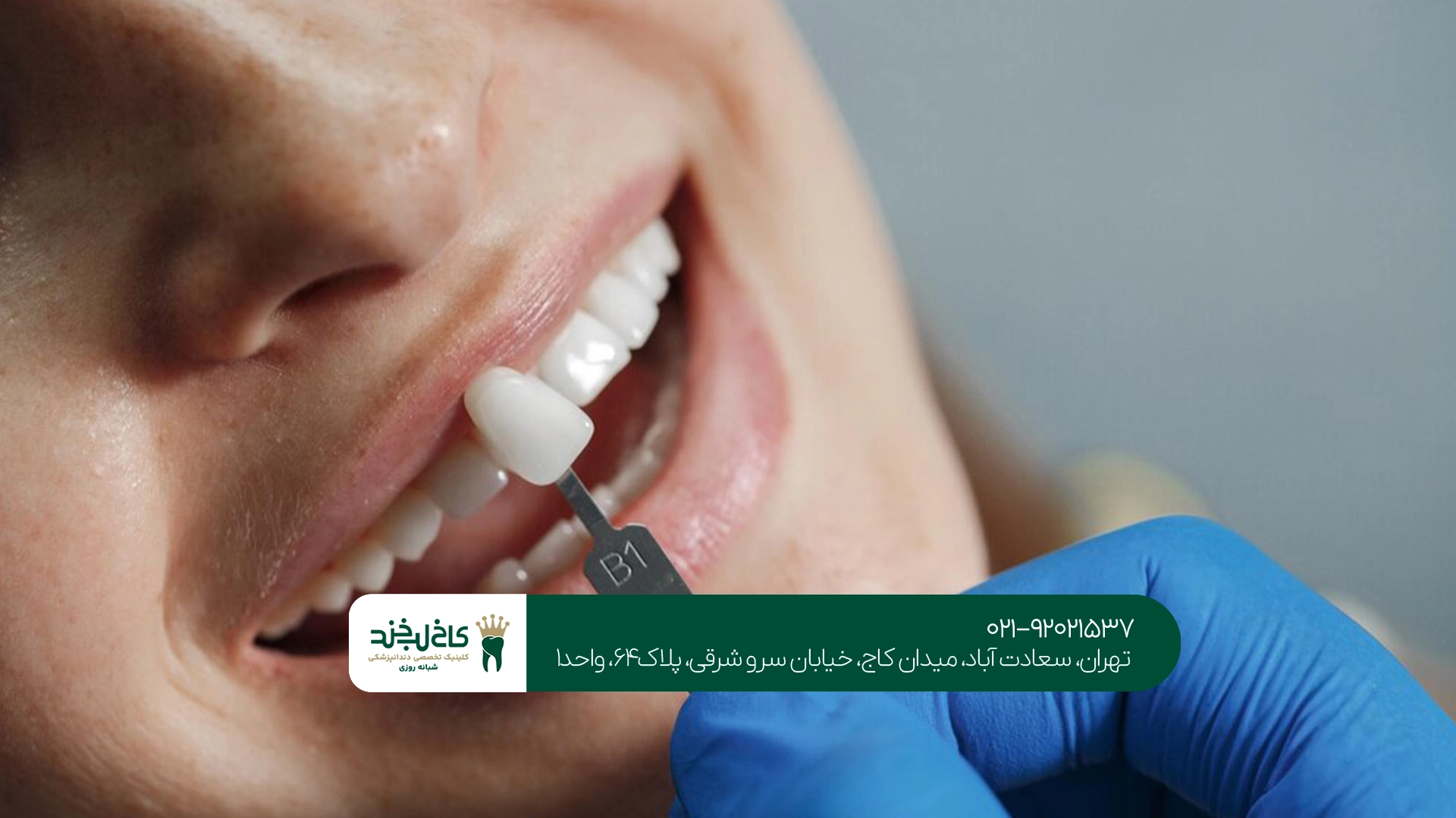 بهترین کامپوزیت دندان برای دندانهای کوچک